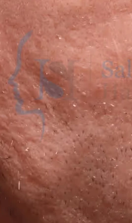 Close-up before and after images showing reduced acne scars and smoother skin texture on a man's cheek.