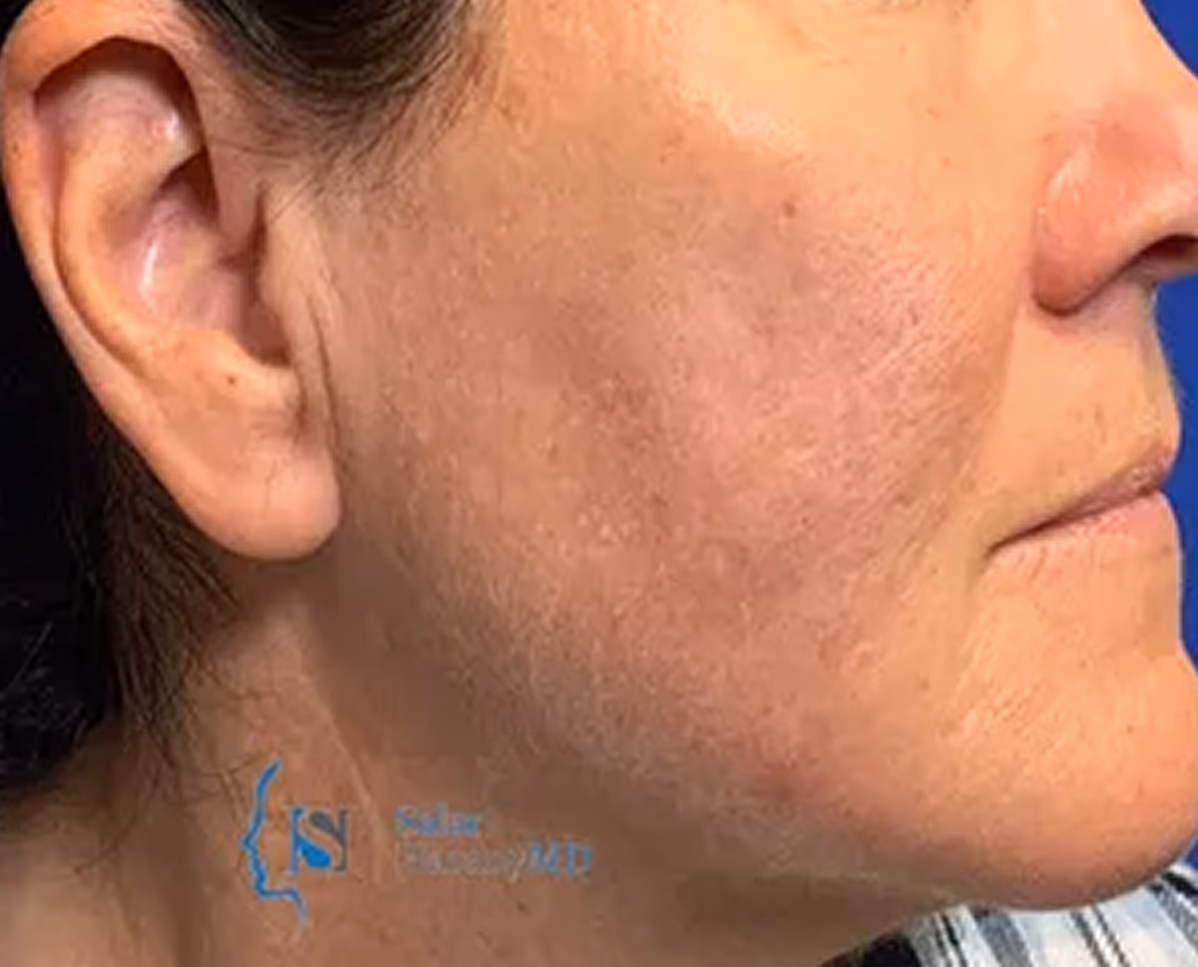 Close-up of a person's right cheek showing skin texture and pores on tanned skin.