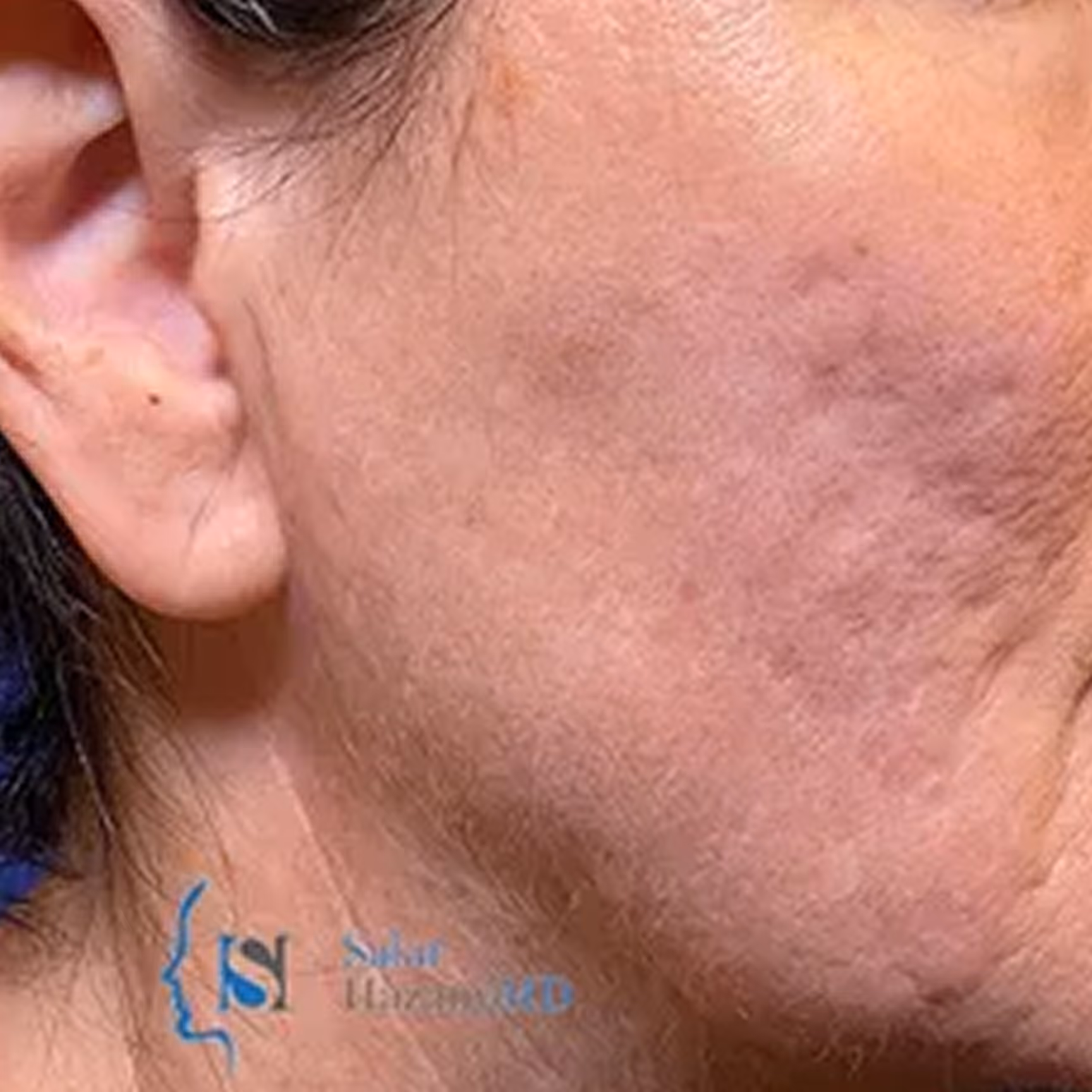 Close-up of a human ear and part of the cheek against a blue background.