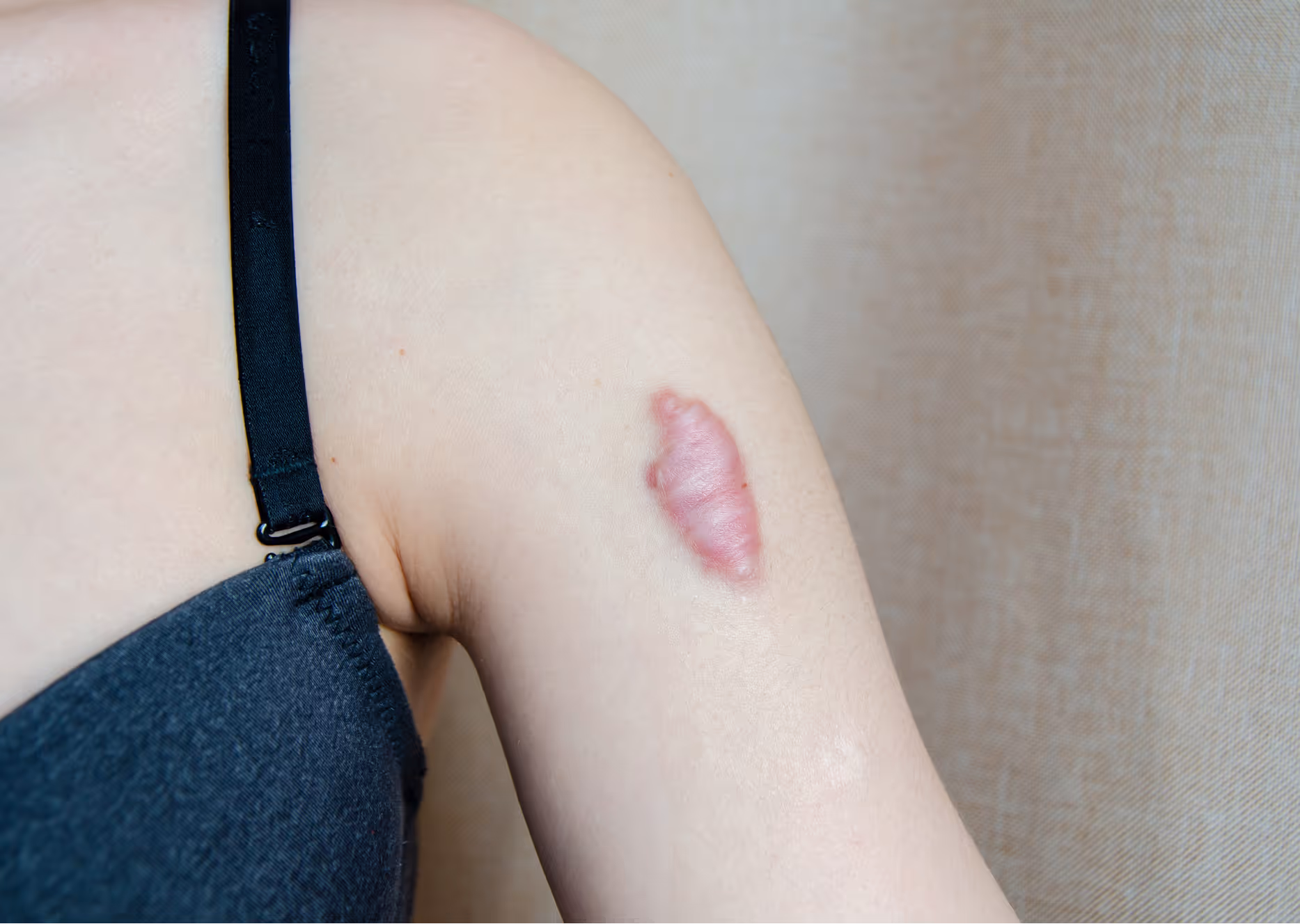 Close-up of a raised, pink keloid scar on a person's upper arm near a black bra strap.