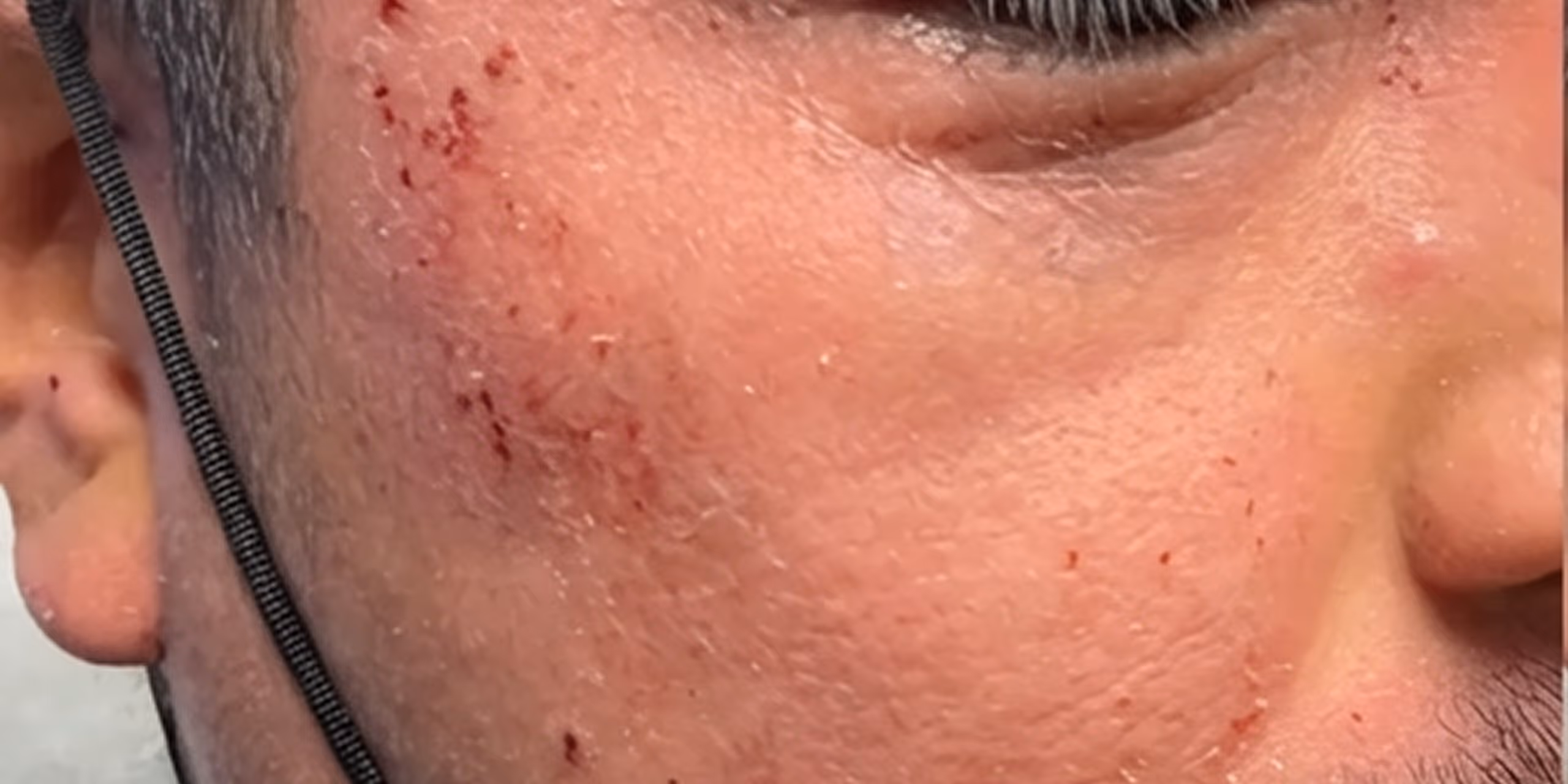 Close-up of a man's cheek with small red scratches and abrasions, wearing a black earphone cord.
