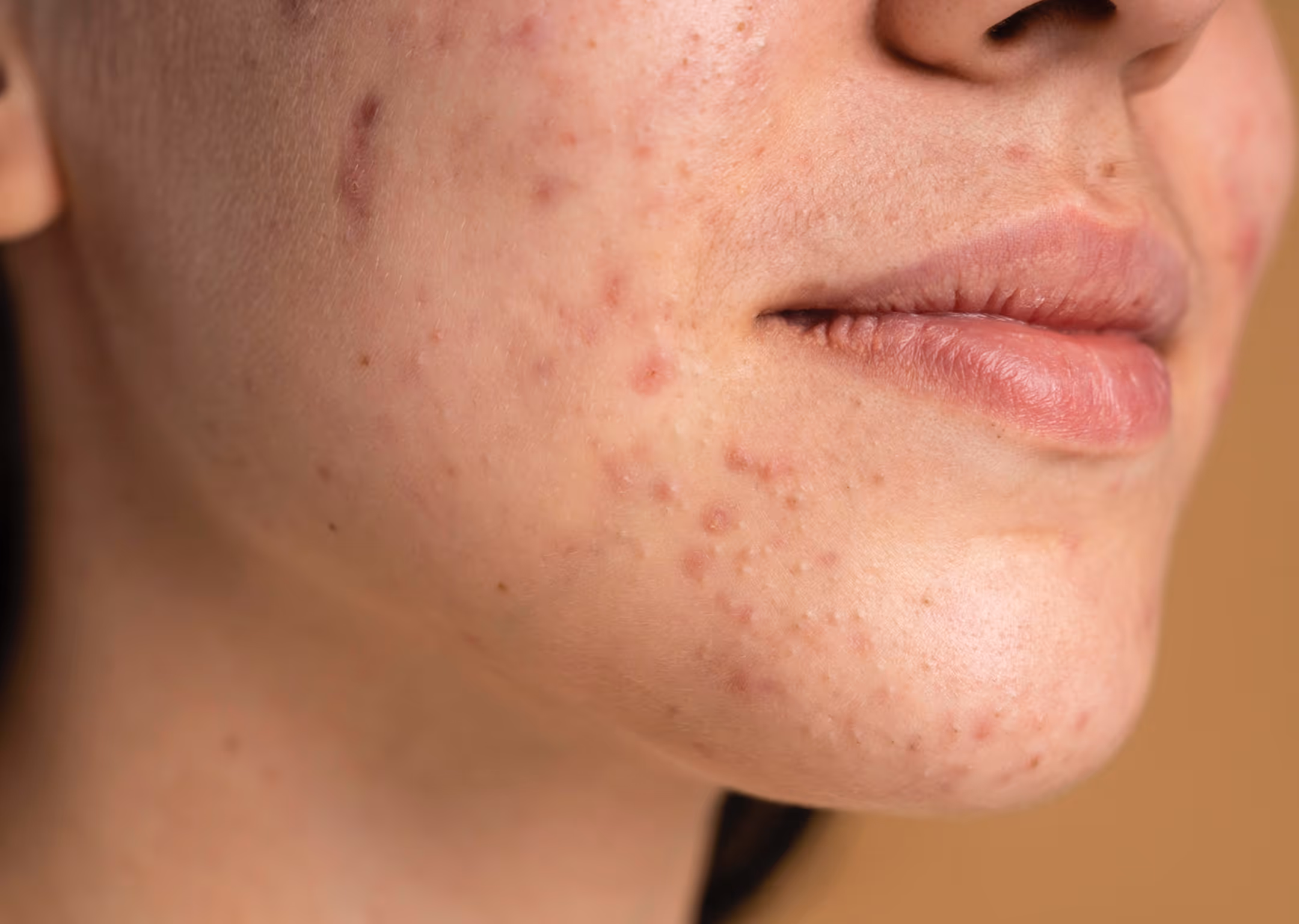 Close-up of a person's cheek and chin with visible acne and blemishes on the skin.