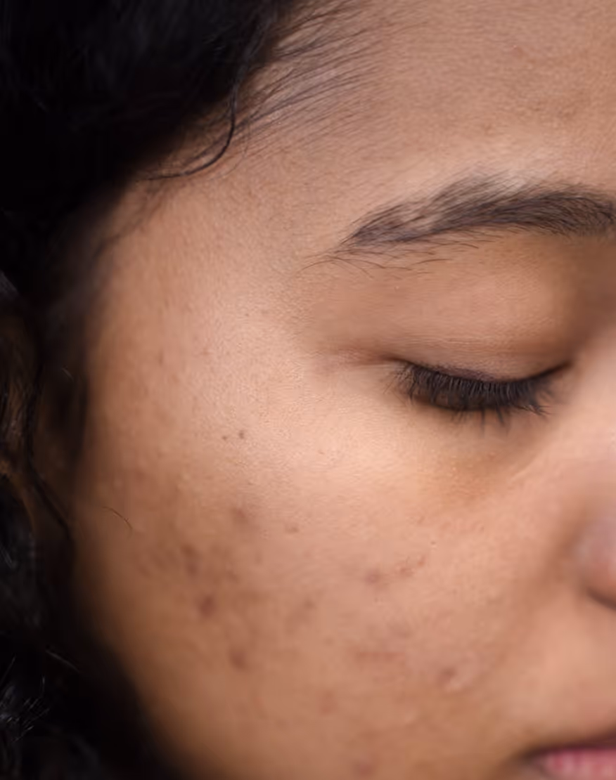 Close-up of a person's cheek with visible acne scars and closed eye.