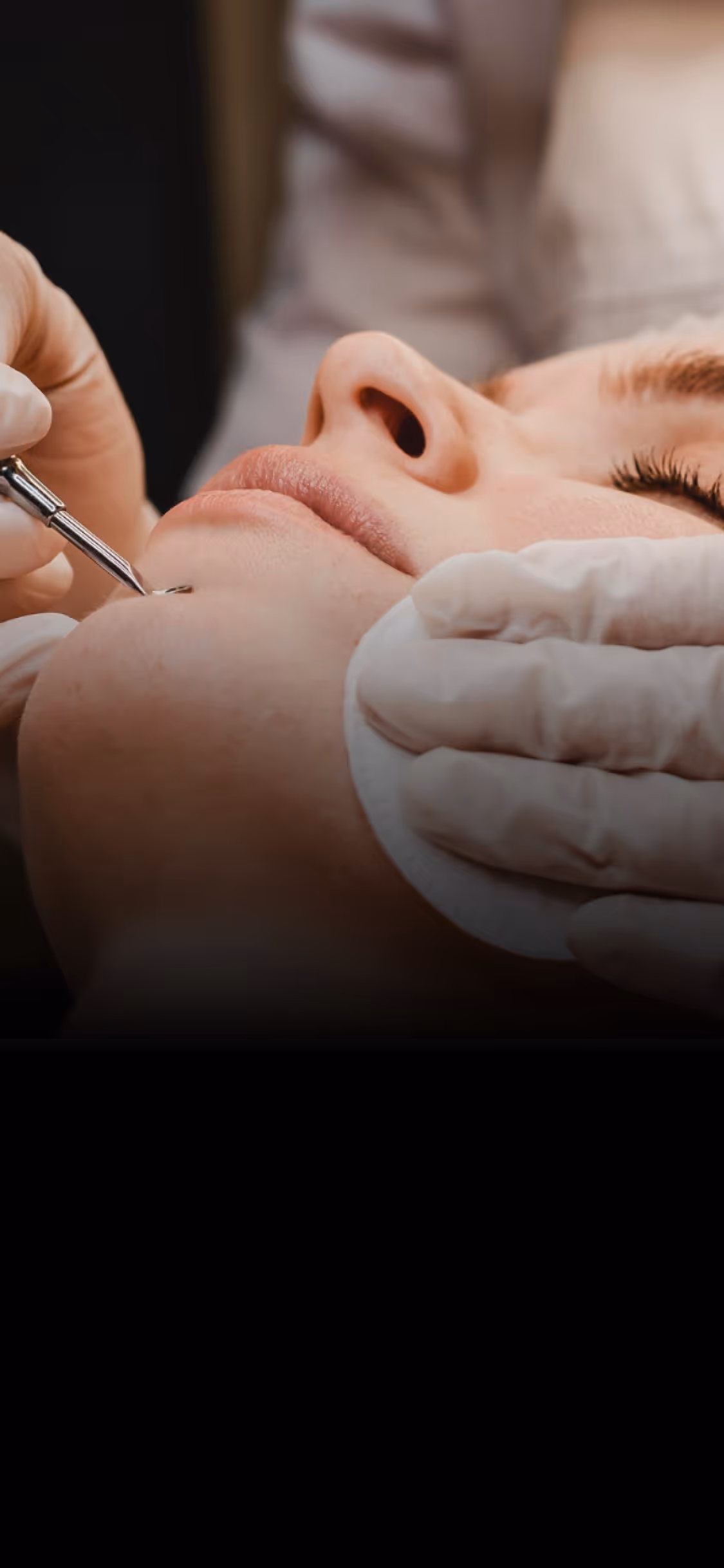 Close-up of a gloved hand using a tool to extract a blemish on a woman's chin.