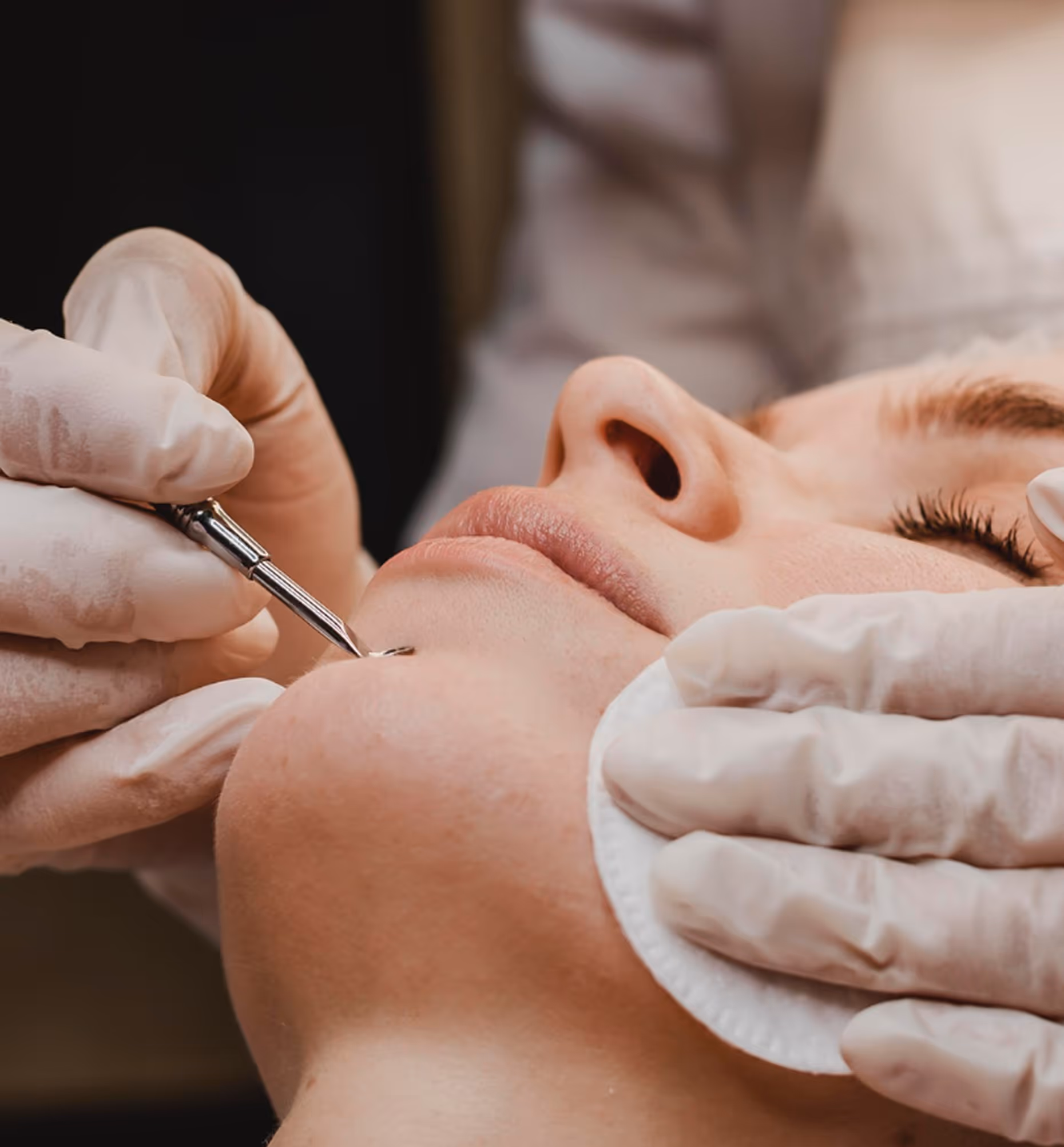 A gloved hand is extracting a blackhead from a person's chin with a metal tool and cotton pad.