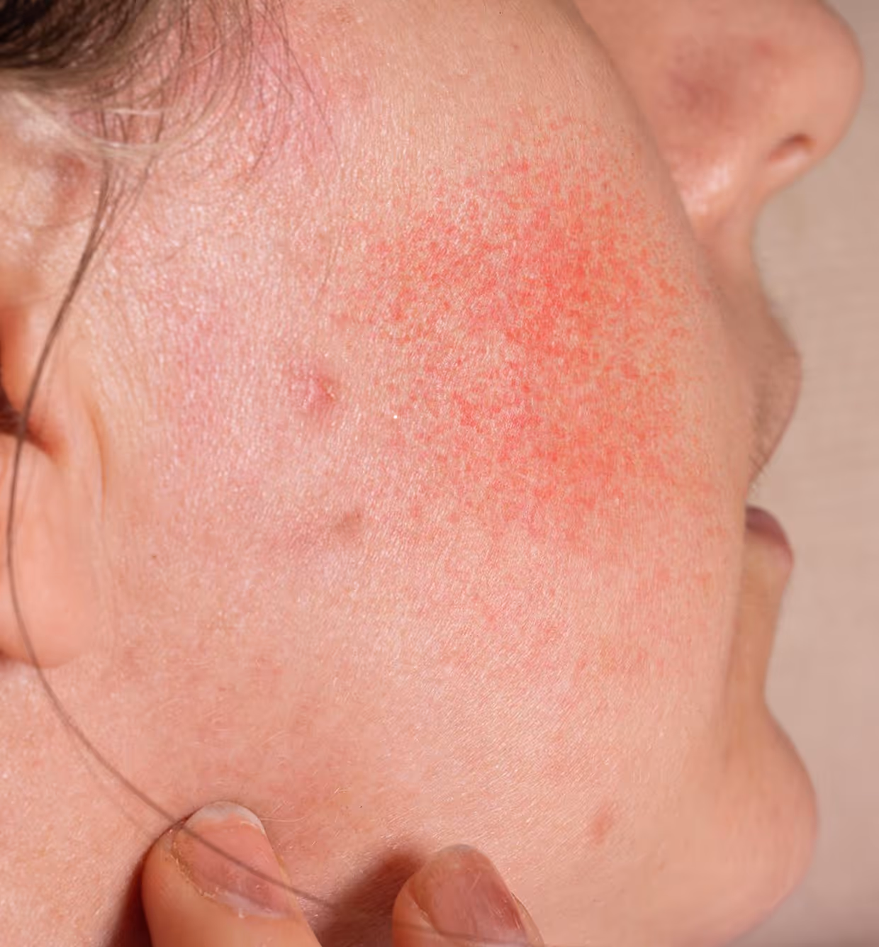 Close-up of a person's cheek with red rash and some acne spots near the nose and ear.
