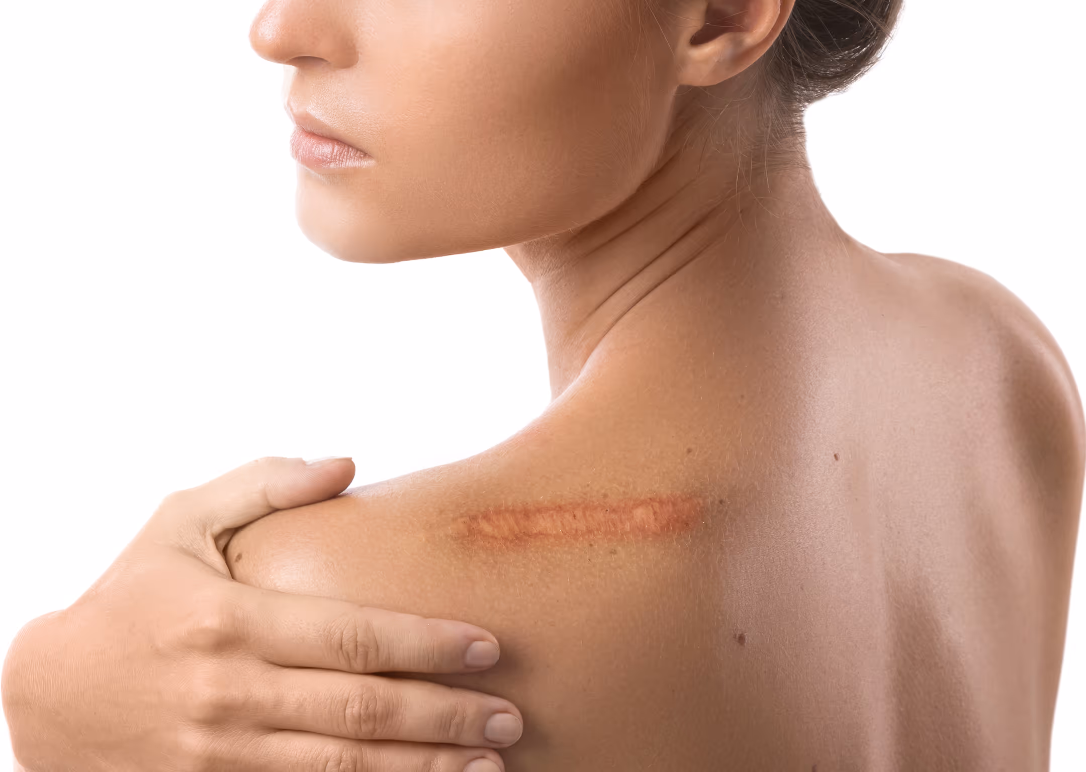 Woman holding her shoulder with a visible red scar on the upper back near the shoulder blade.