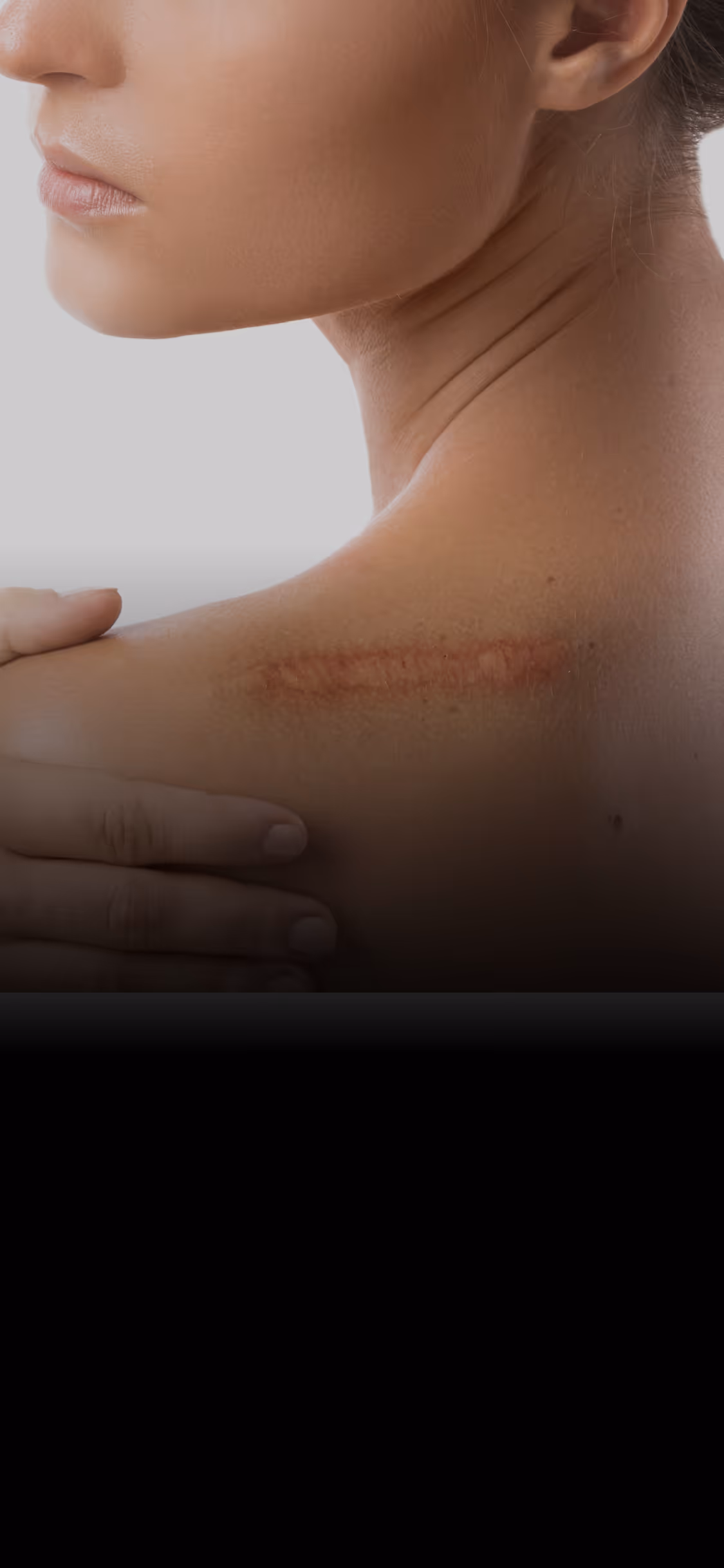 Woman showing a faded scar on her left shoulder while touching it with her right hand.