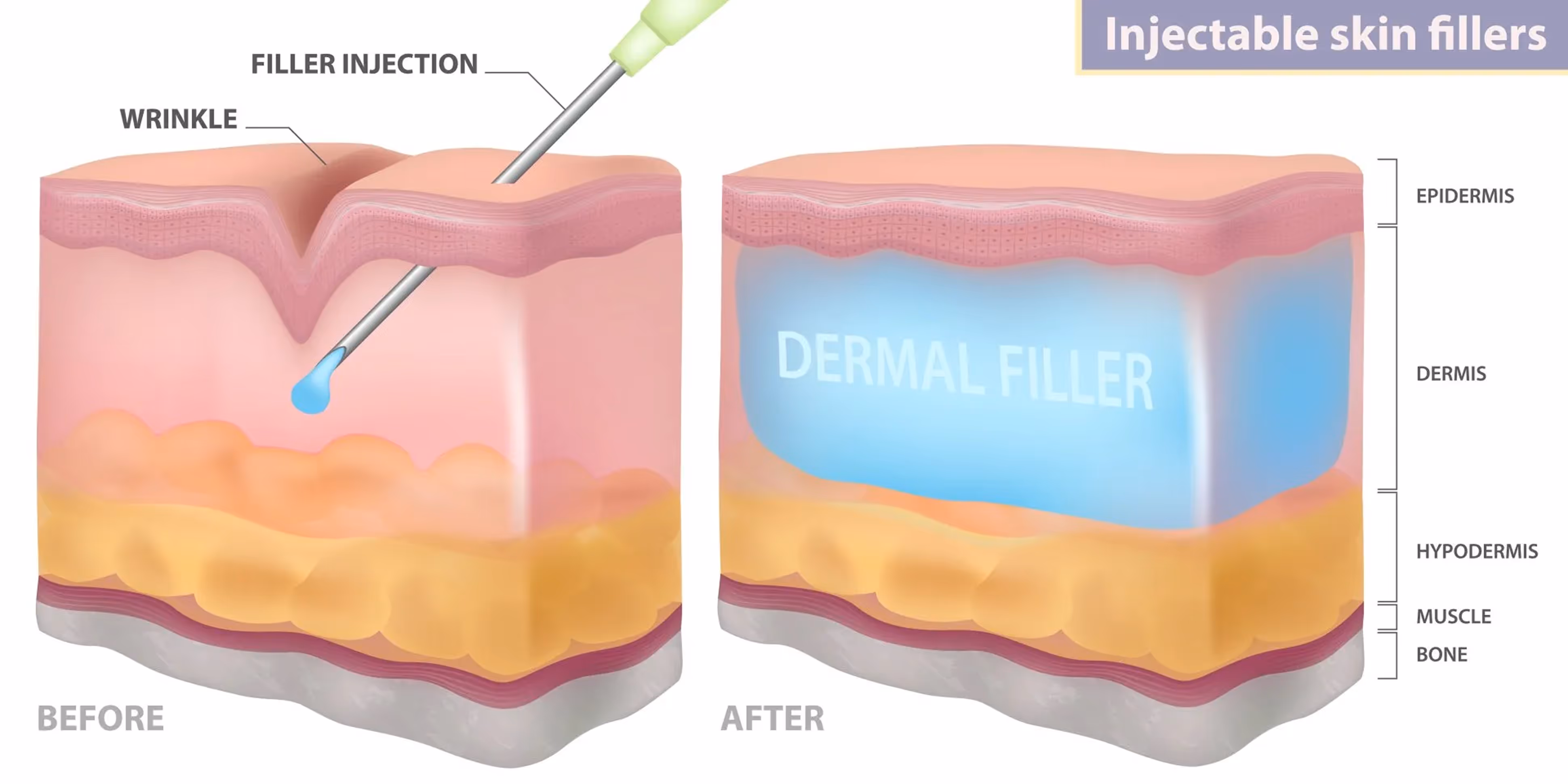 Skin cross-section showing filler injection smoothing wrinkle by filling dermis layer with dermal filler.