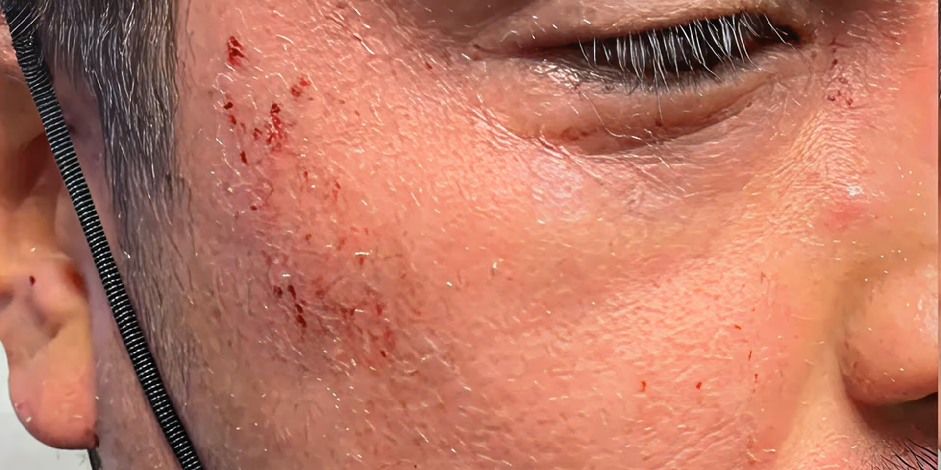 Close-up of a person’s cheek showing small blood spots and dry skin near a closed eye.