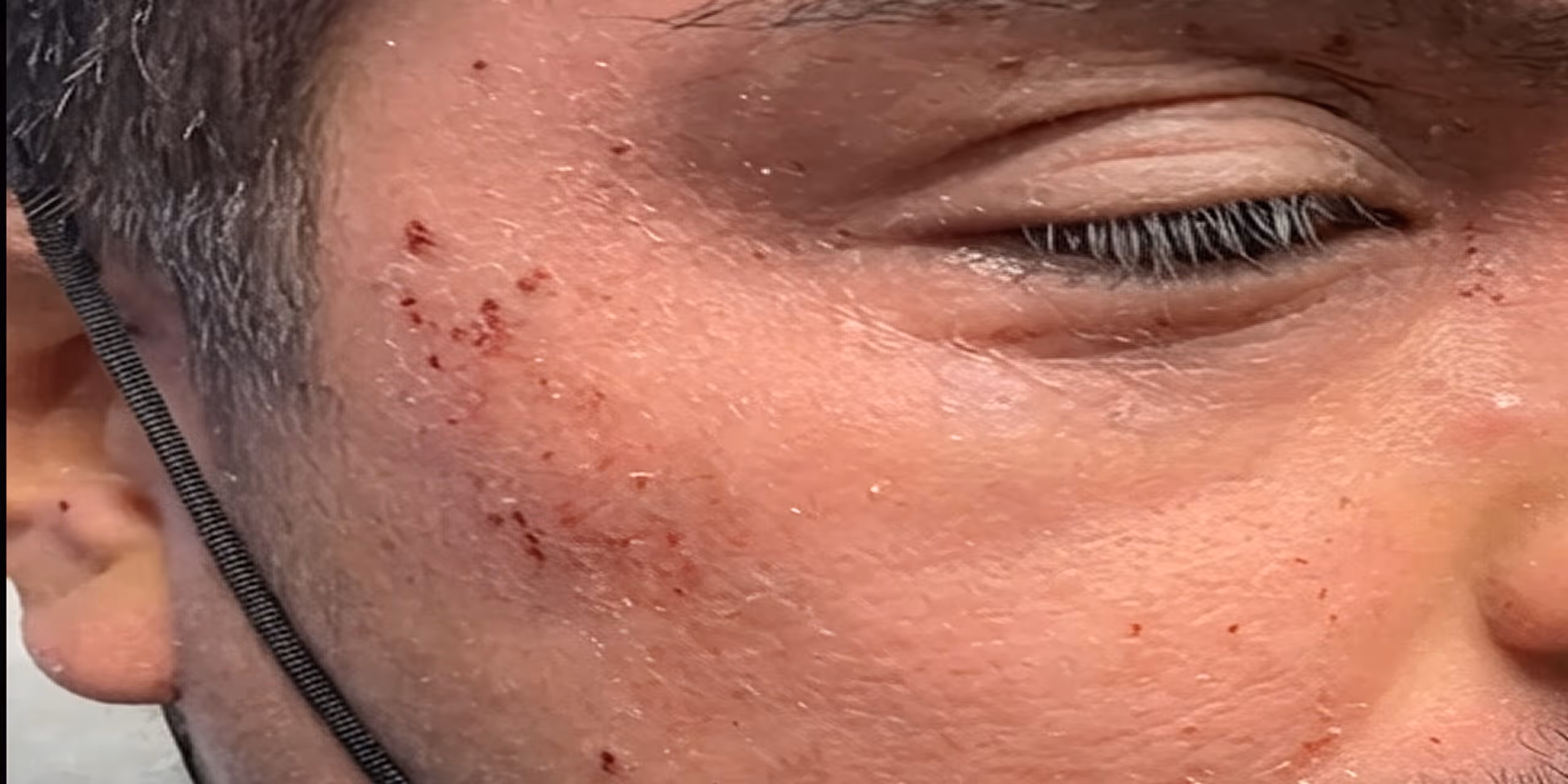 Close-up of a person’s cheek showing small blood spots and dry skin near a closed eye.