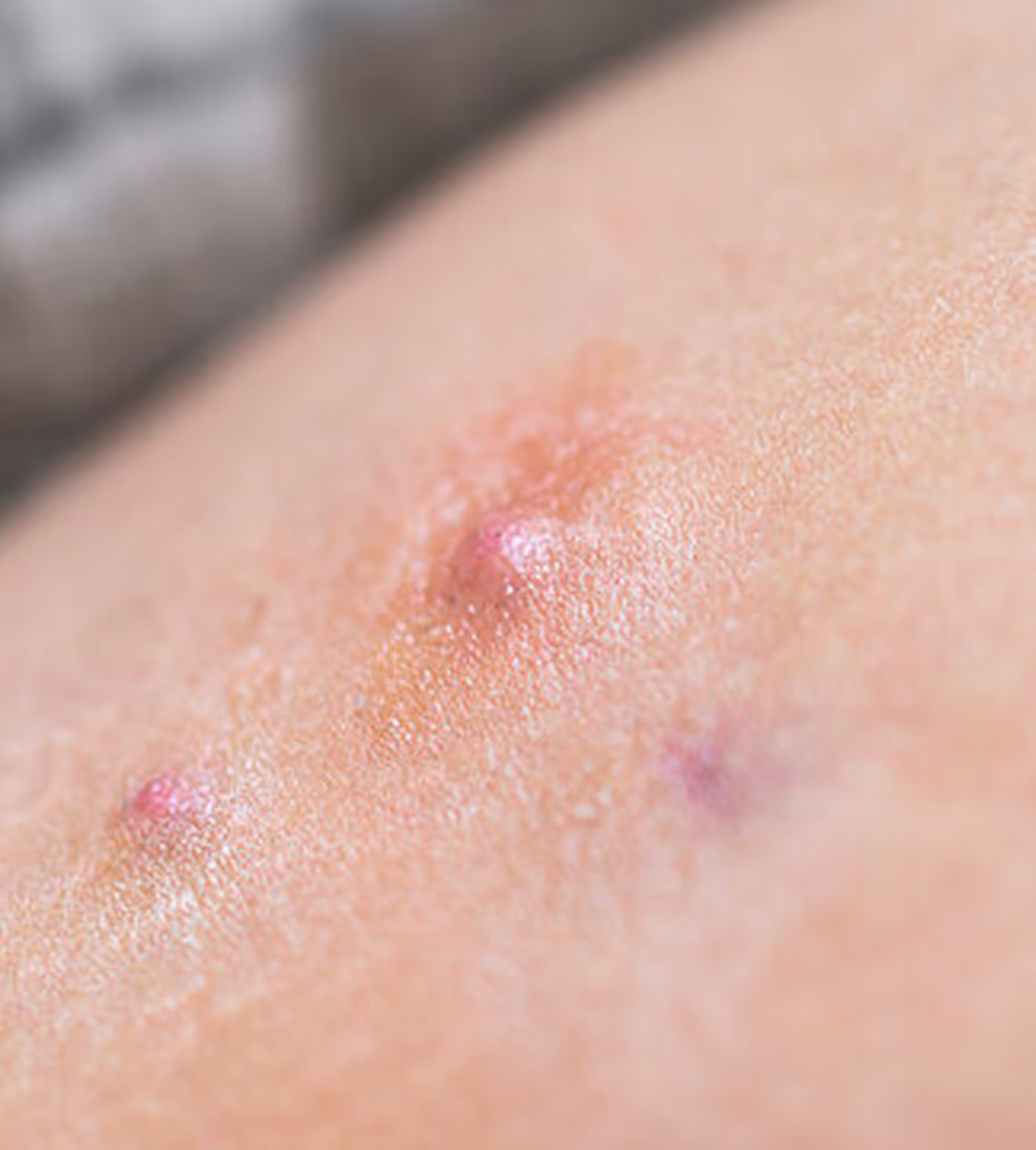 Close-up of skin with small red and purple irritated bumps indicating possible acne or rash.