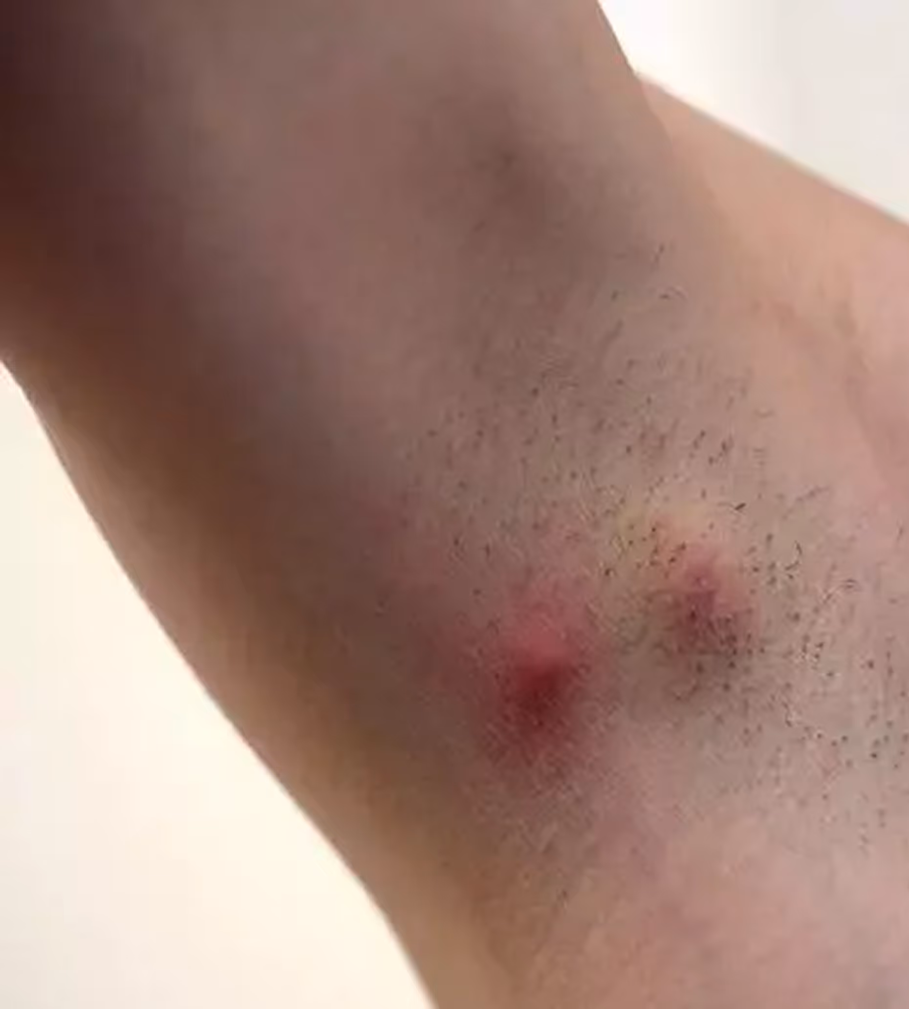 Close-up of a forearm with two red, swollen insect bites surrounded by minor bruising.