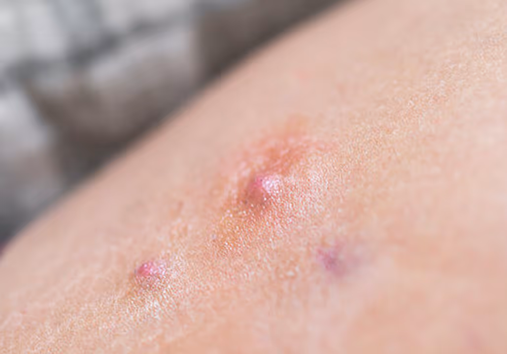 Close-up of skin with acne showing red inflamed pimples and bumps.