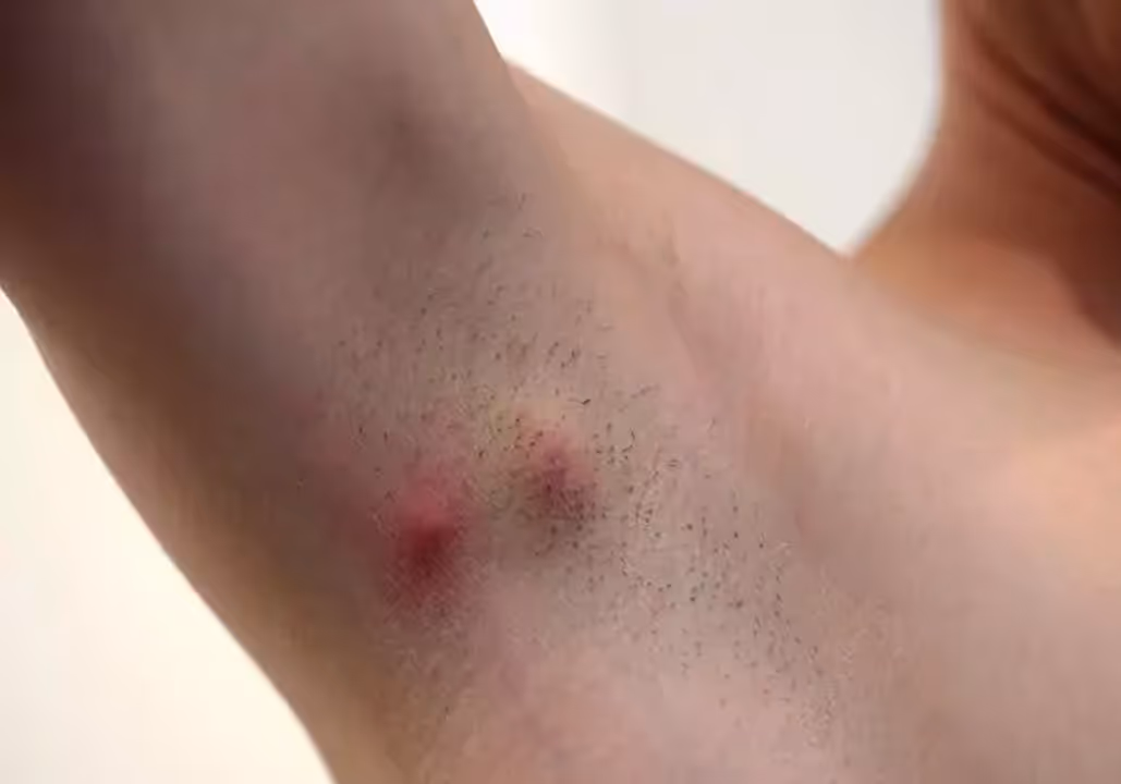 Close-up of an armpit with two red, irritated bumps and some hair stubble on the skin.