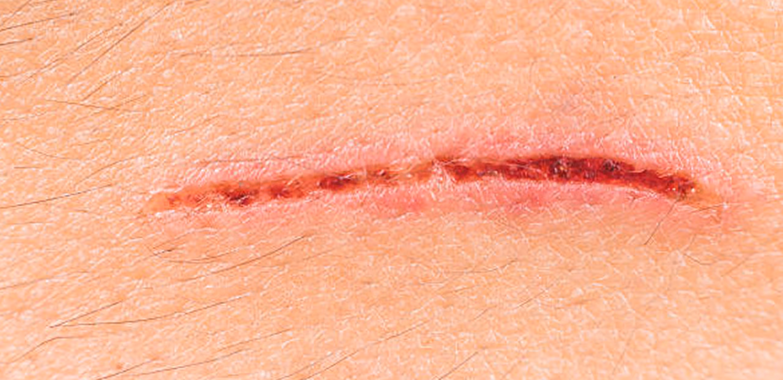 Close-up of a healing linear cut on skin with scab formation and slight redness.