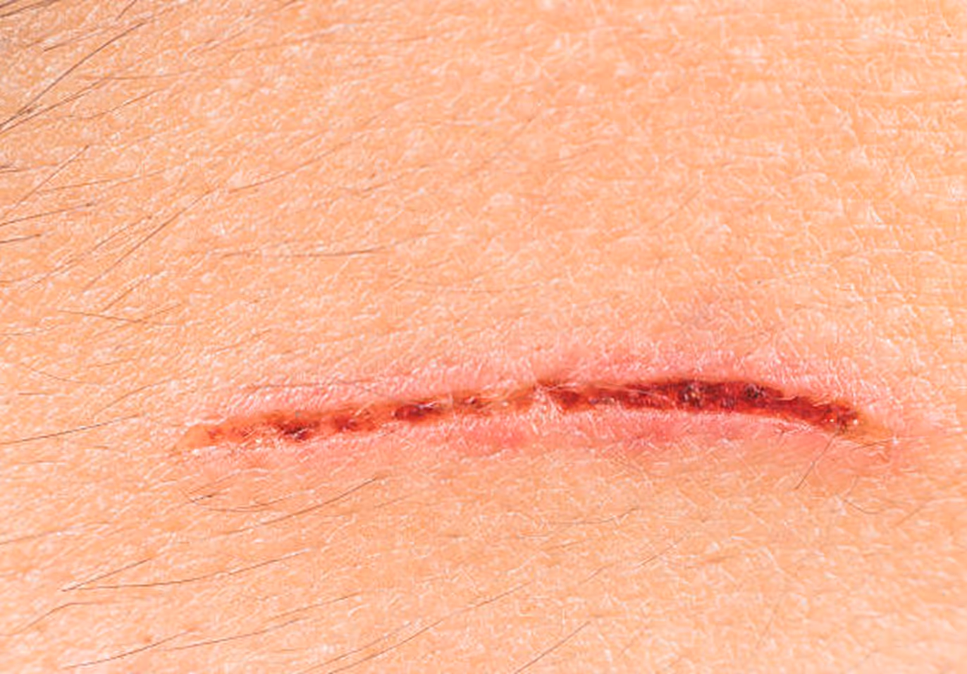 Close-up of a fresh cut or scratch on skin with visible redness and slight bleeding.