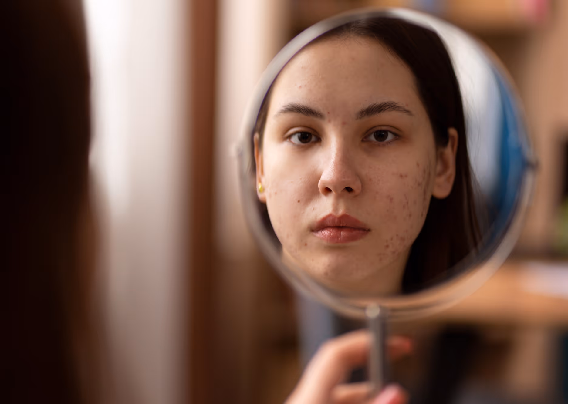Young woman looking at her acne-affected face in a handheld mirror.