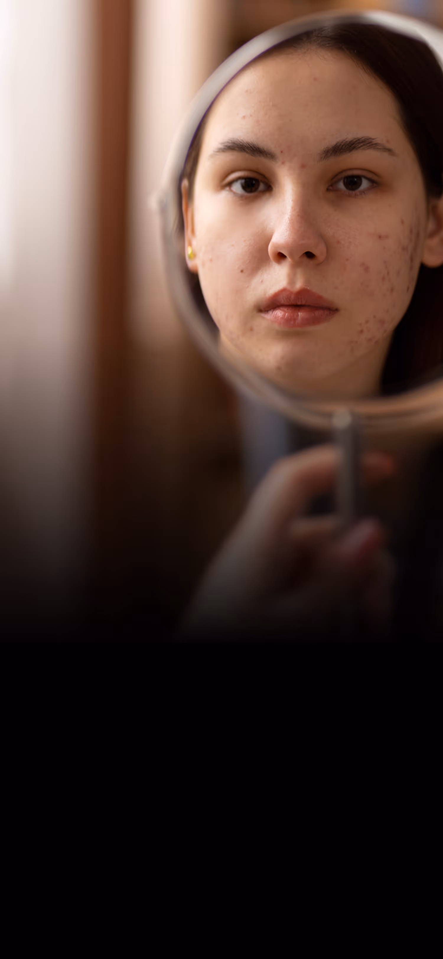 Young woman with acne looking at her reflection in a handheld round mirror.