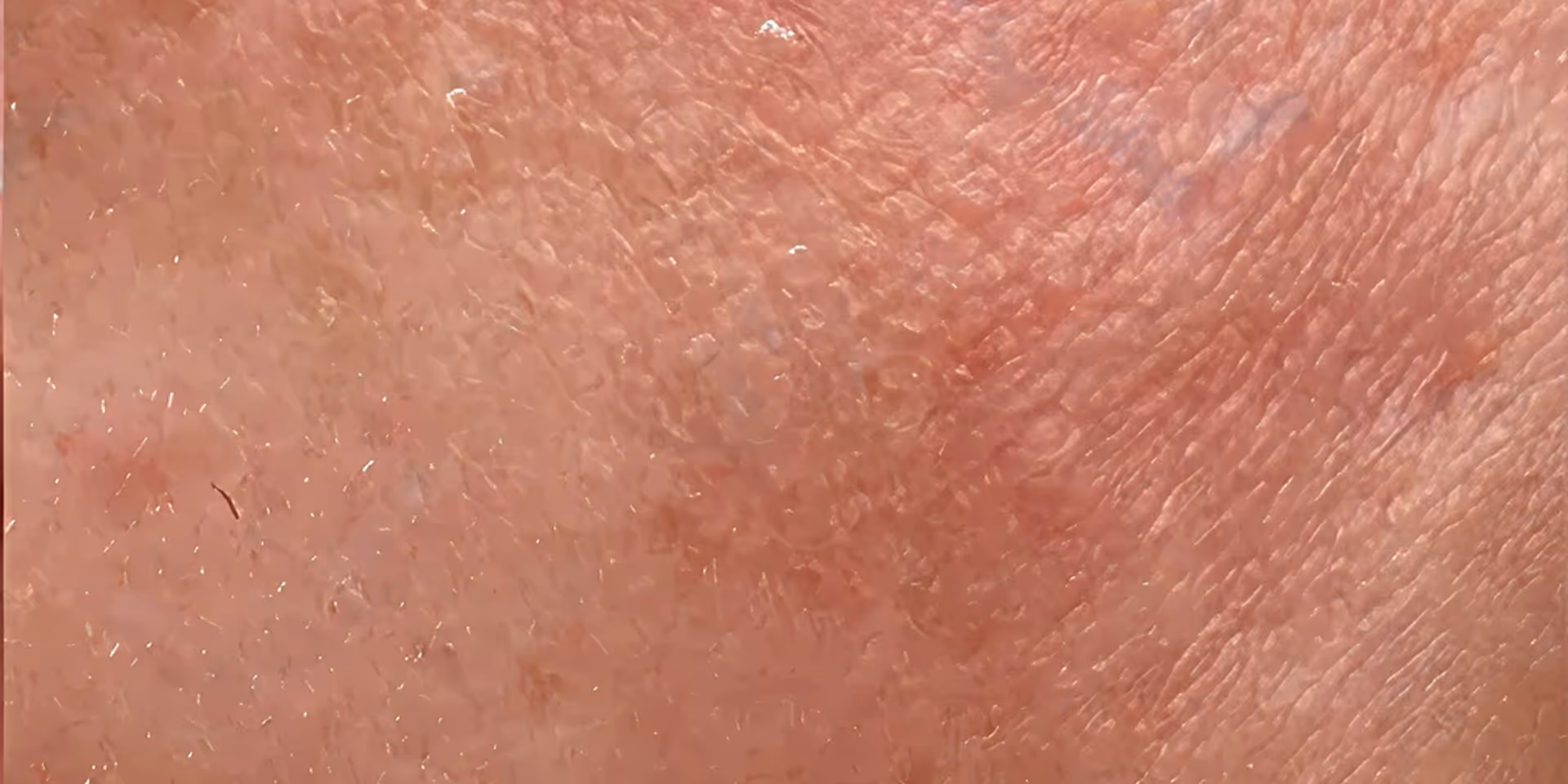 Close-up of facial skin showing redness, dry patches, and textured irritation near the eye.
