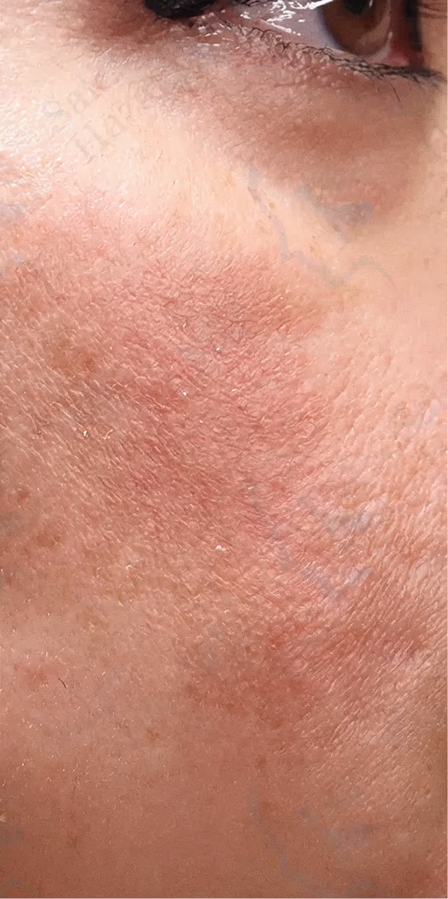 Close-up of facial skin showing redness, dry patches, and textured irritation near the eye.