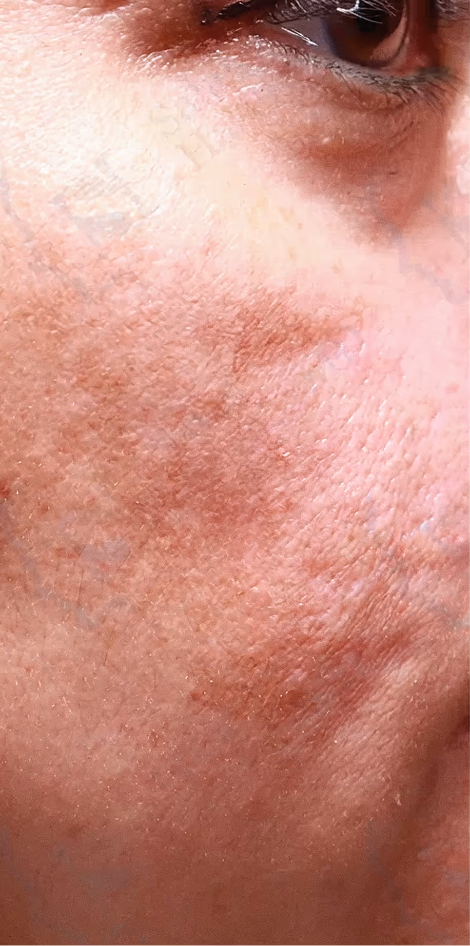 Close-up of human cheek showing skin texture with pores, fine lines, and some redness.