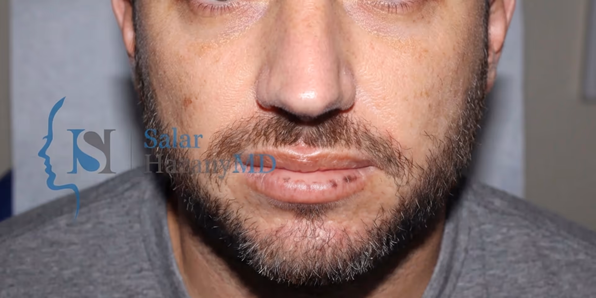 Close-up of a man's lower face showing healing stitches on his lower lip and a short beard.