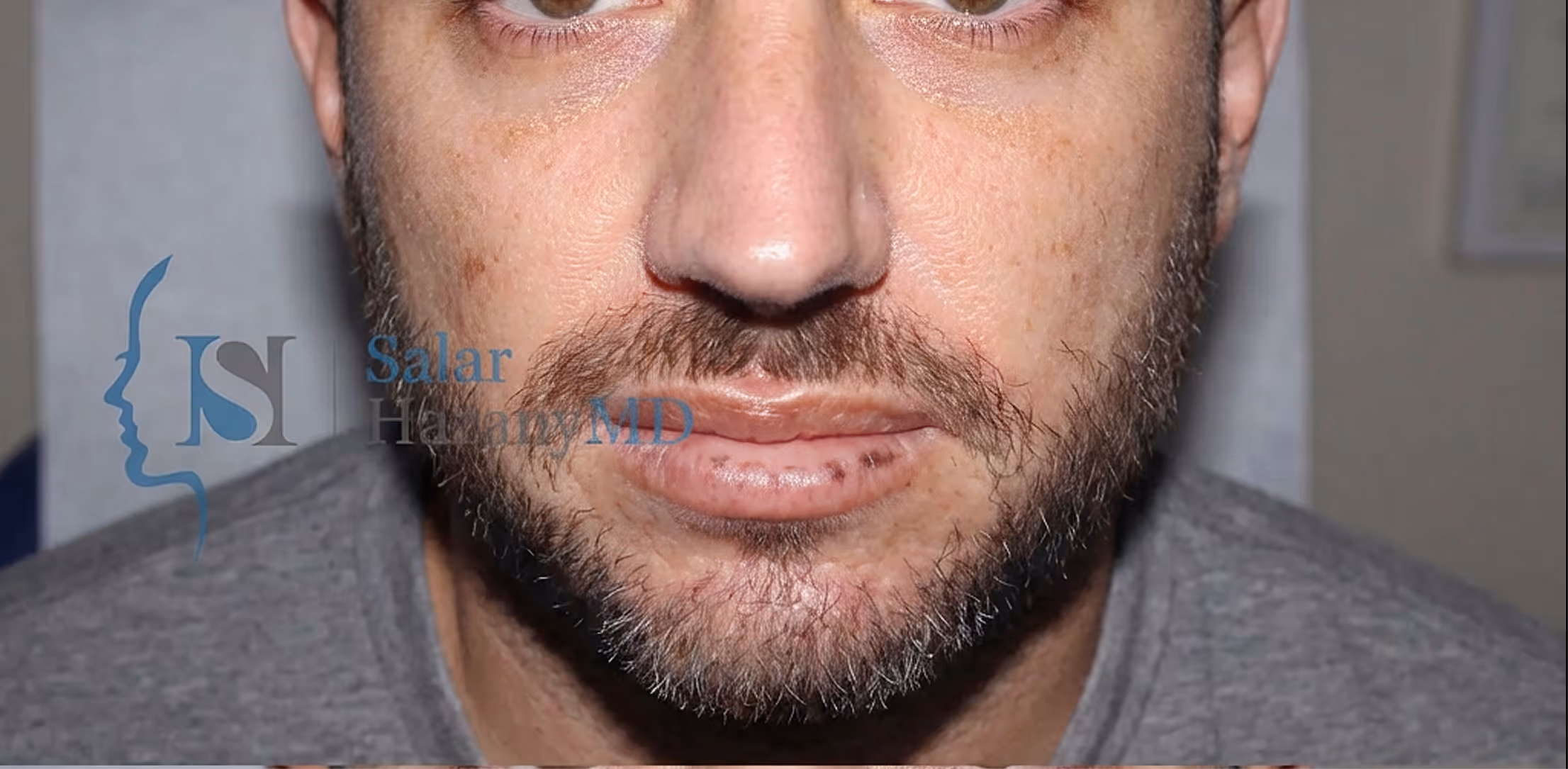 Close-up of a man's lower face showing healing stitches on his lower lip and a short beard.