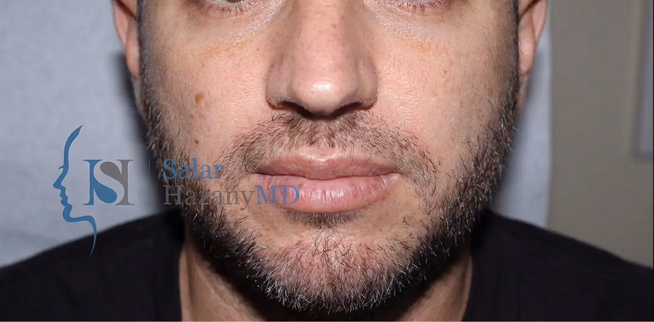 Close-up of a man's lower face with patchy beard growth and some skin spots.