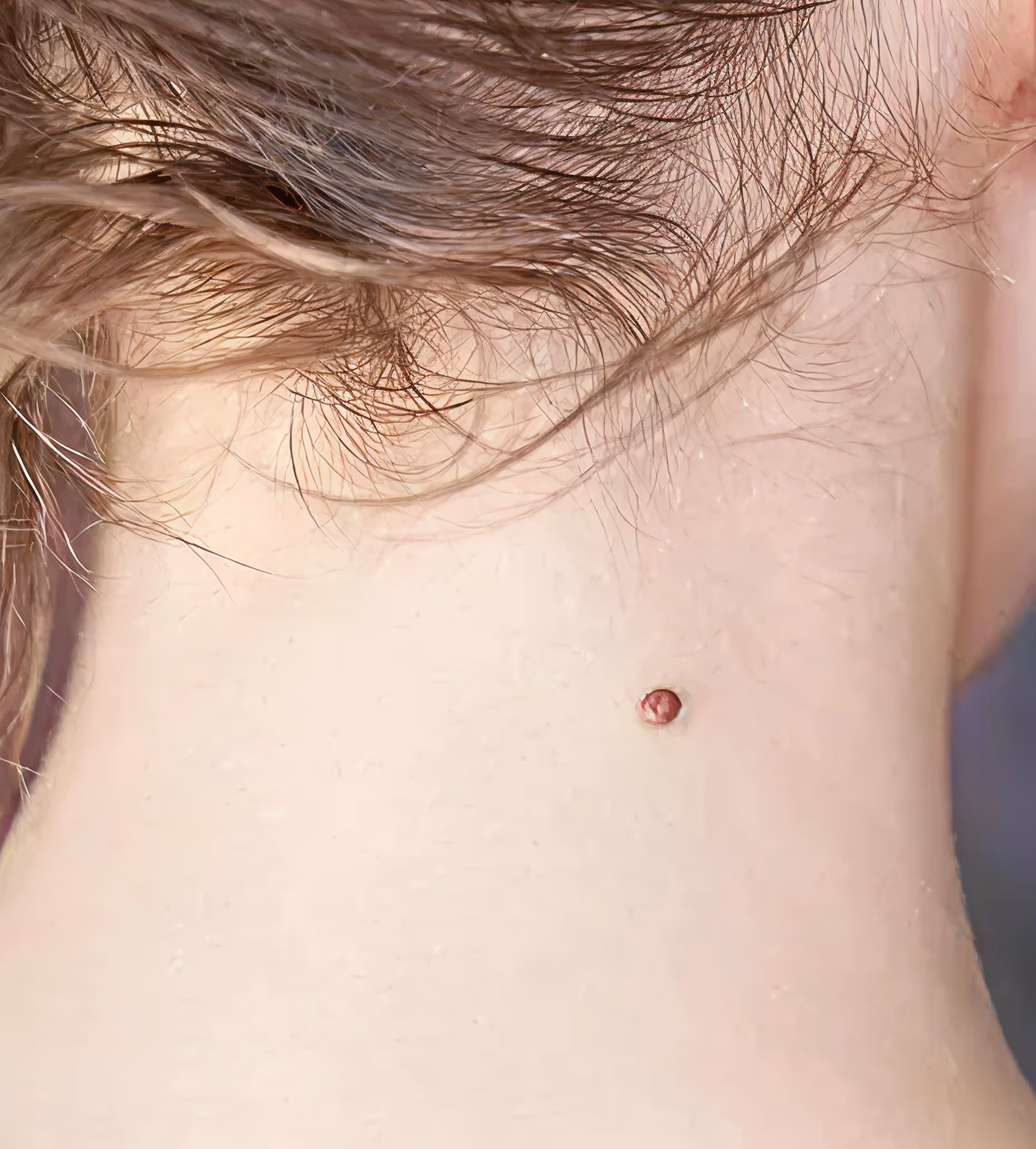 Close-up of a small, round, raised brown mole near the hairline on the back of a person's neck.