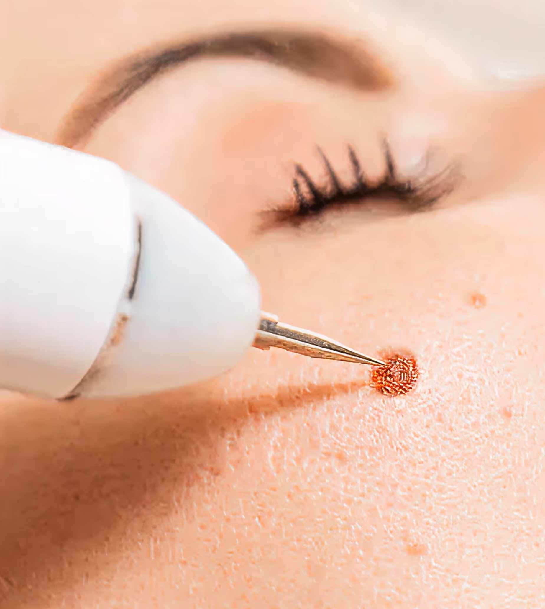 Close-up of a laser device targeting a skin spot on a person's closed eye face.