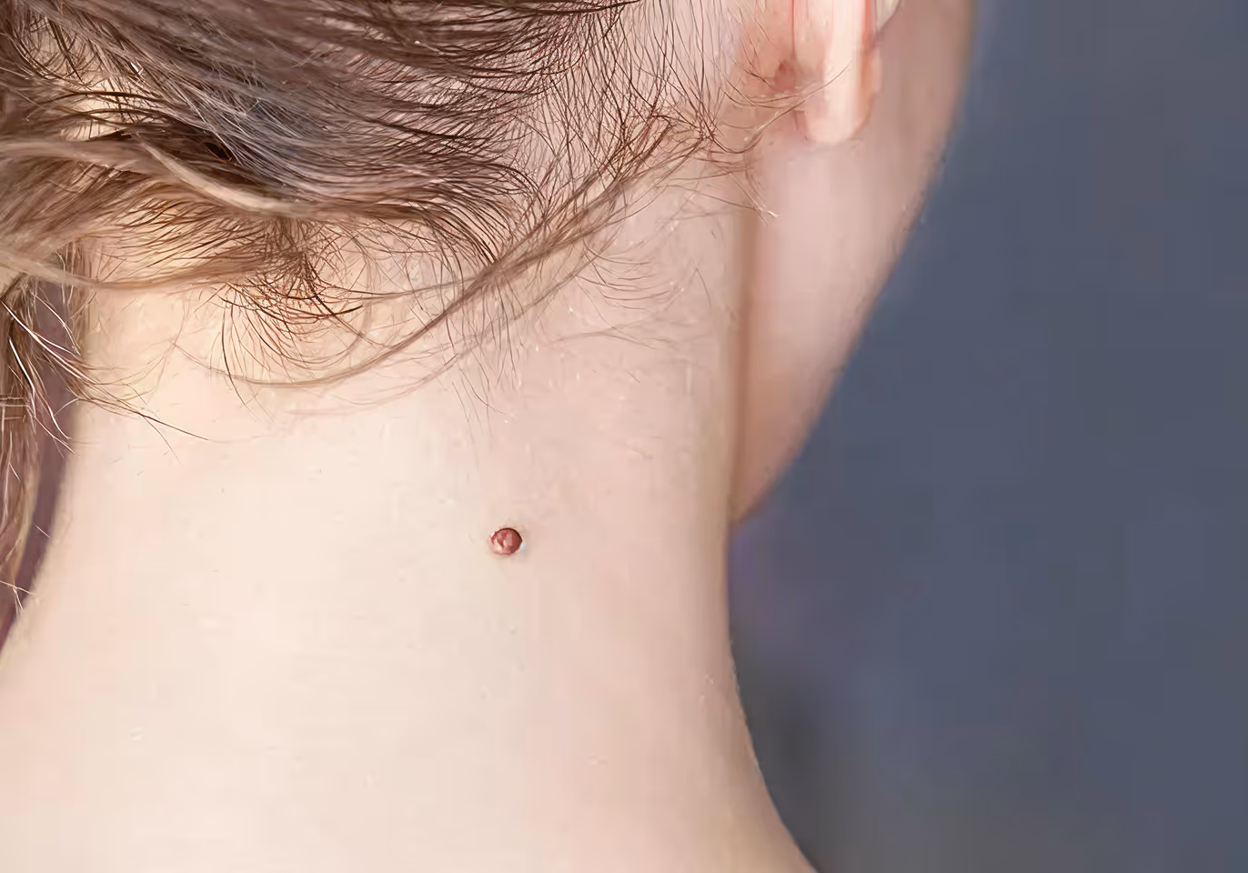 Close-up of a neck with a small raised reddish mole or skin tag under light brown hair.