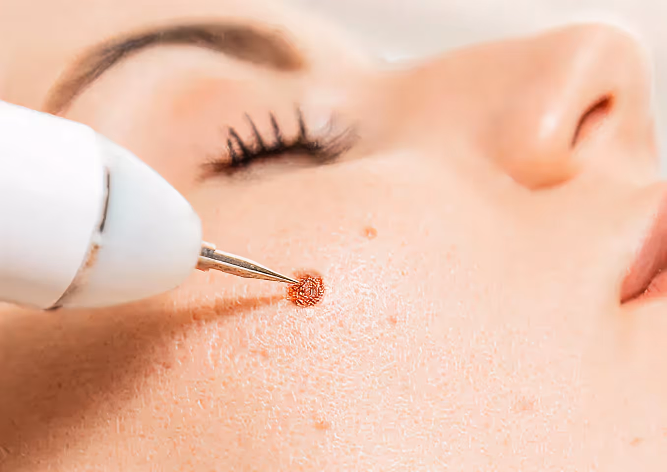 Close-up of a device treating a skin lesion on a person's cheek near the nose.