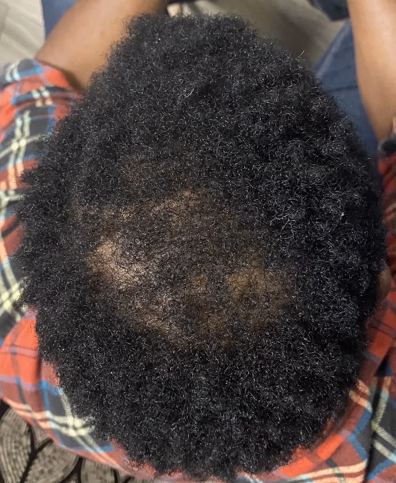 Top view of a person with curly black hair showing a bald spot on the crown of the head.
