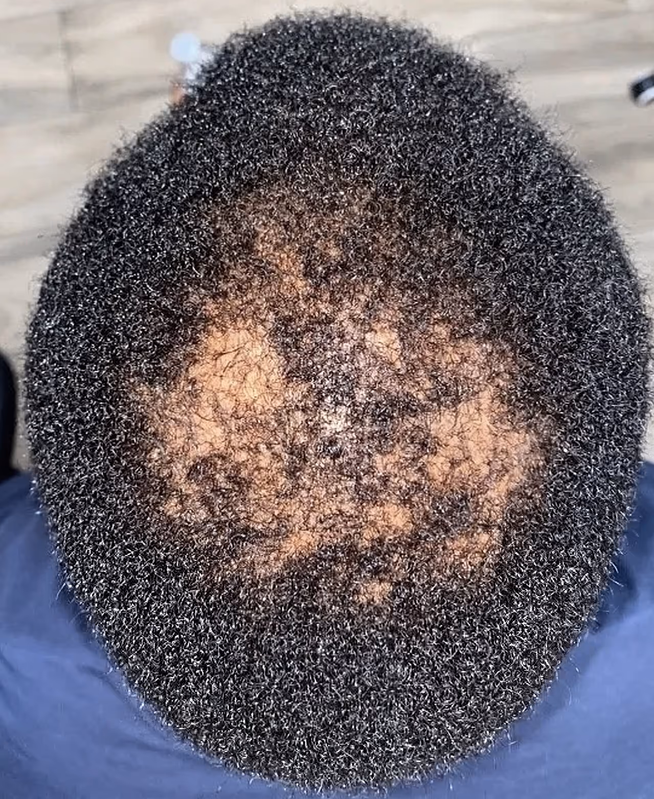 Top view of a person's scalp with thinning and patchy hair loss in the center.