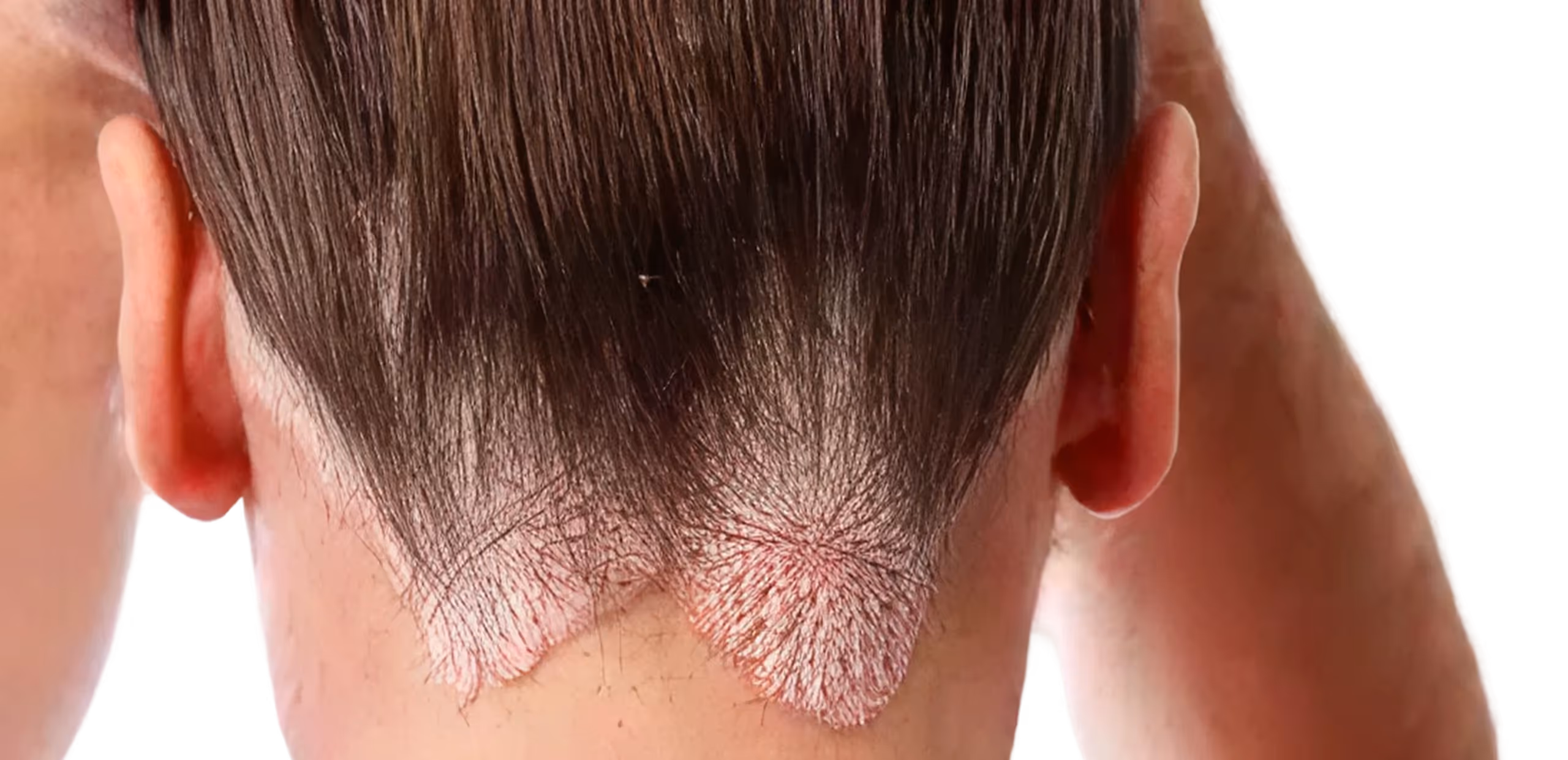 Back of a person's head with red, flaky skin near the neck and short brown hair.