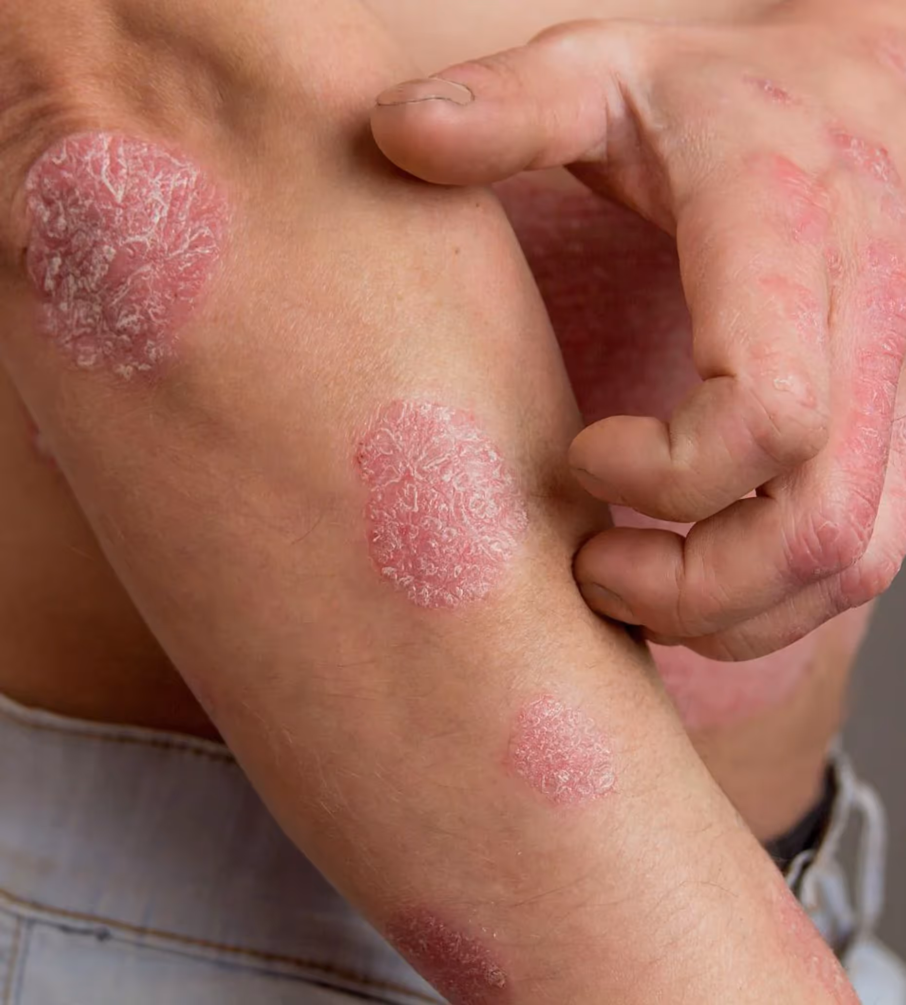 Close-up of arm and hand with red, scaly psoriasis patches on the skin.