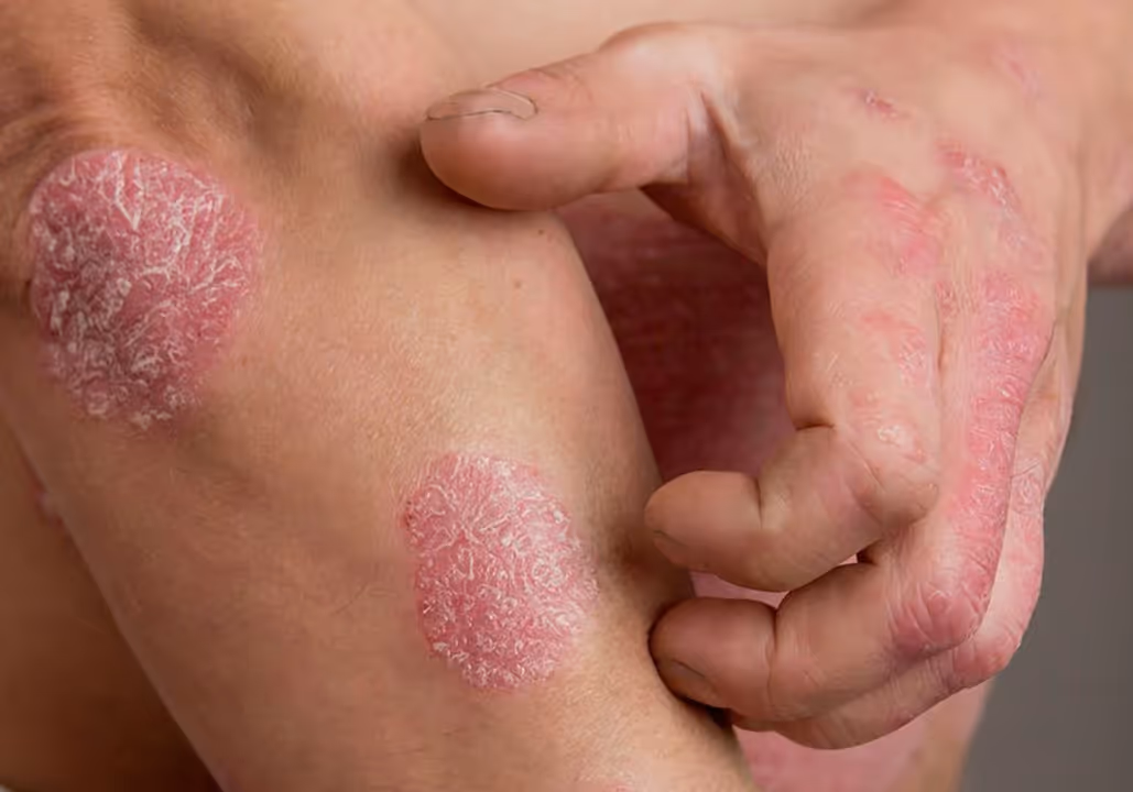 Red, scaly psoriatic patches on leg and hand with visible skin peeling and dryness.