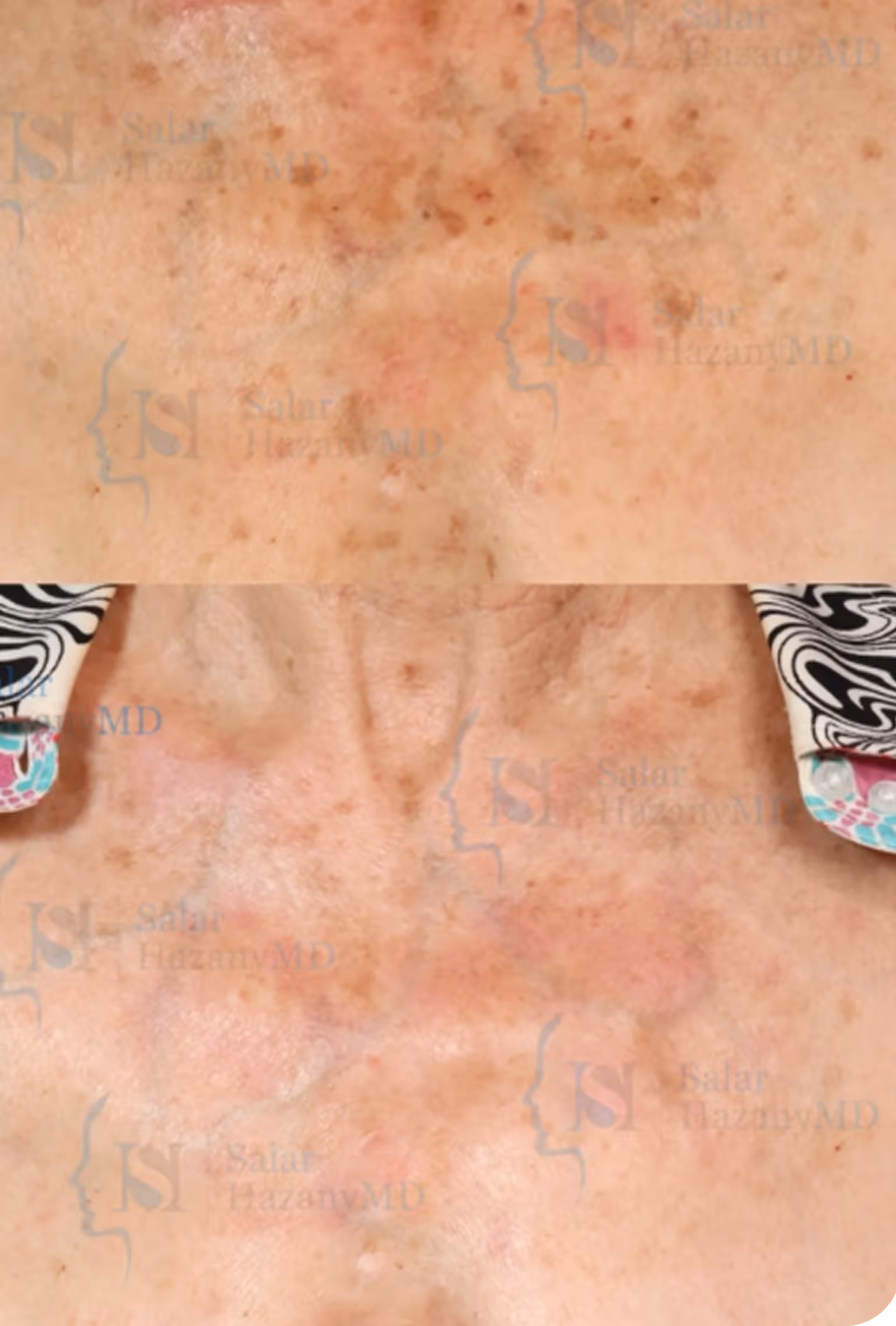 Close-up comparison of aged, sun-damaged skin with brown spots before and after treatment.