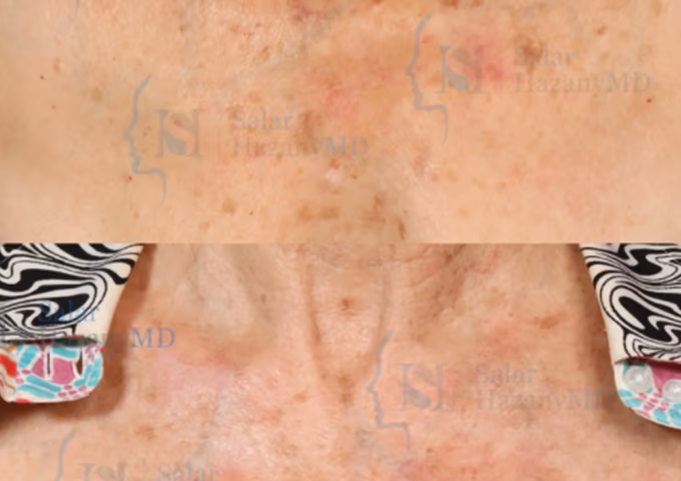 Close-up of an older person's neck with visible age spots and wrinkles wearing a patterned shirt collar.
