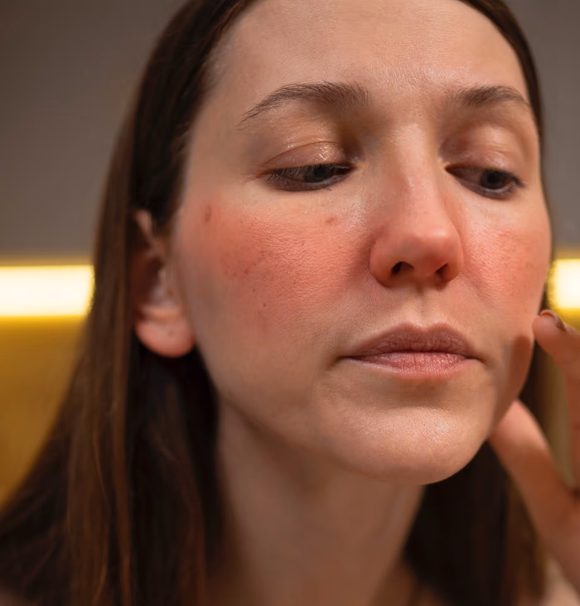 Woman with irritated, red skin on her cheeks touching her face with her fingers.