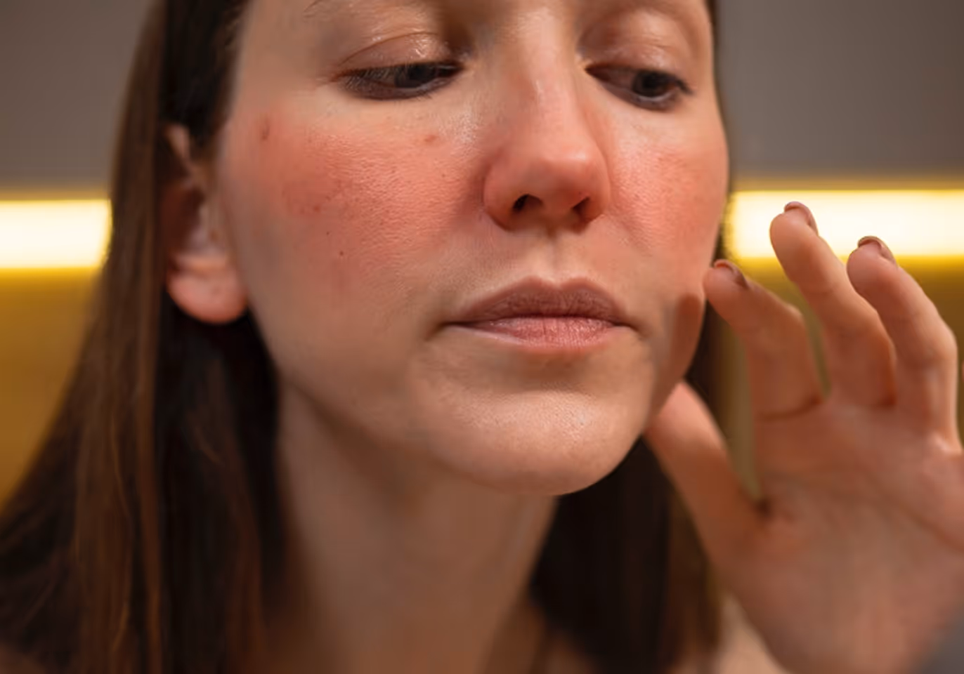 Close-up of woman with red, irritated cheeks touching her face with fingers.