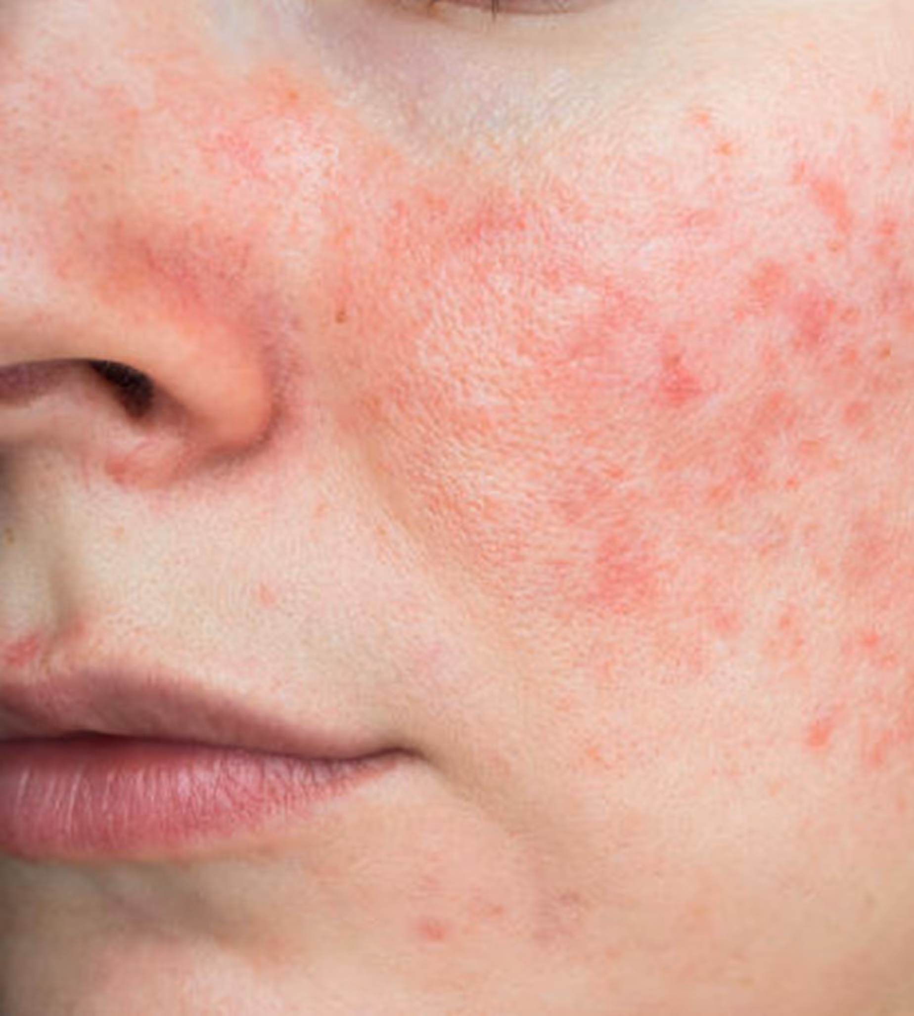 Close-up of a face with red, inflamed acne and blemishes on the cheek and around the nose.