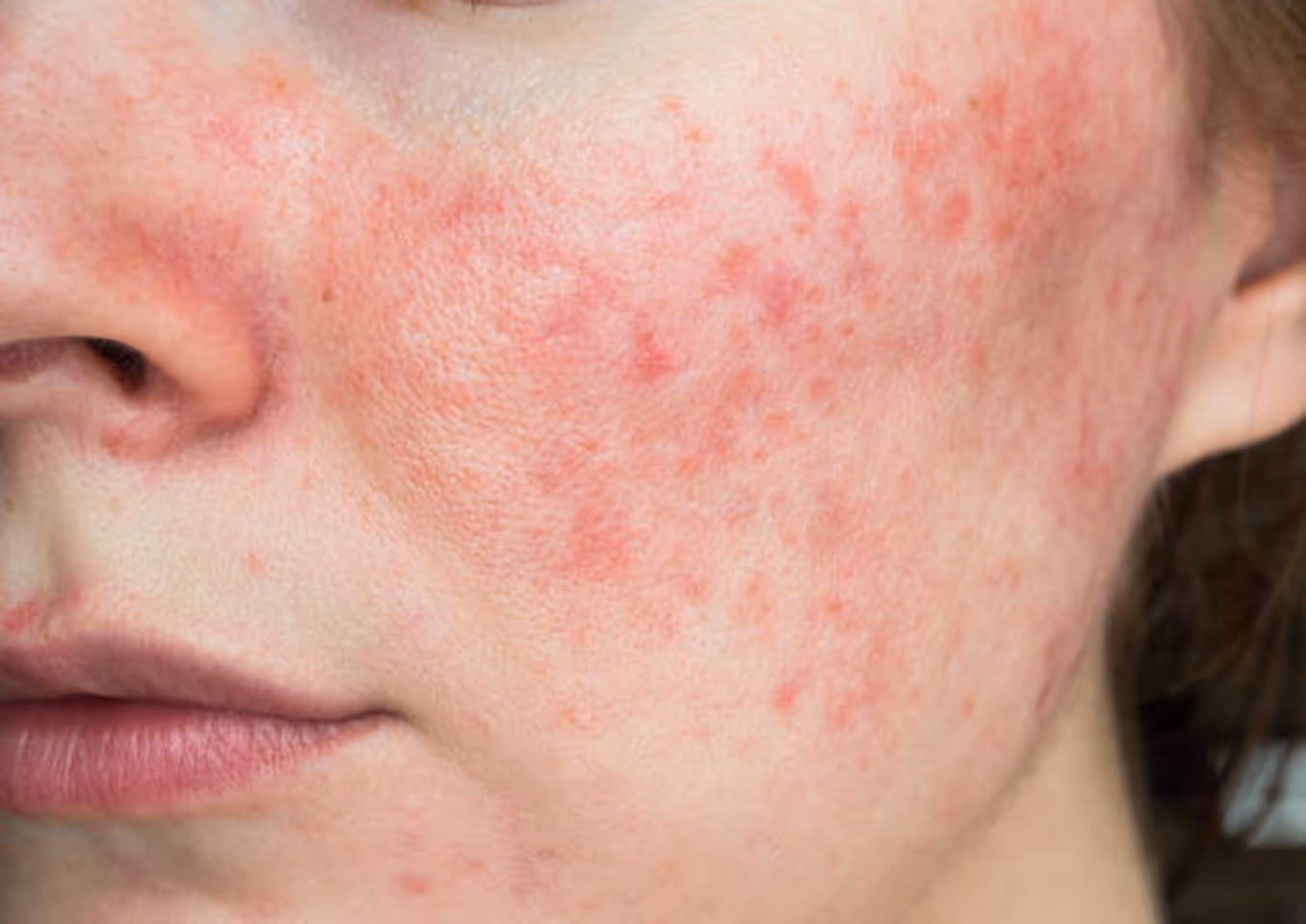 Close-up of a cheek with red, inflamed acne and skin irritation near the nose and lips.