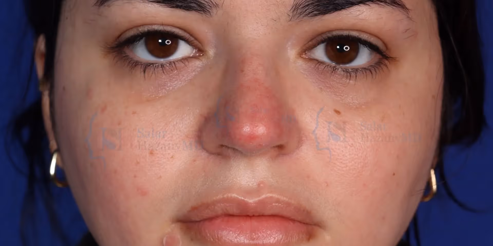 Close-up of a woman's face with a red, inflamed bump on the nose and some freckles.