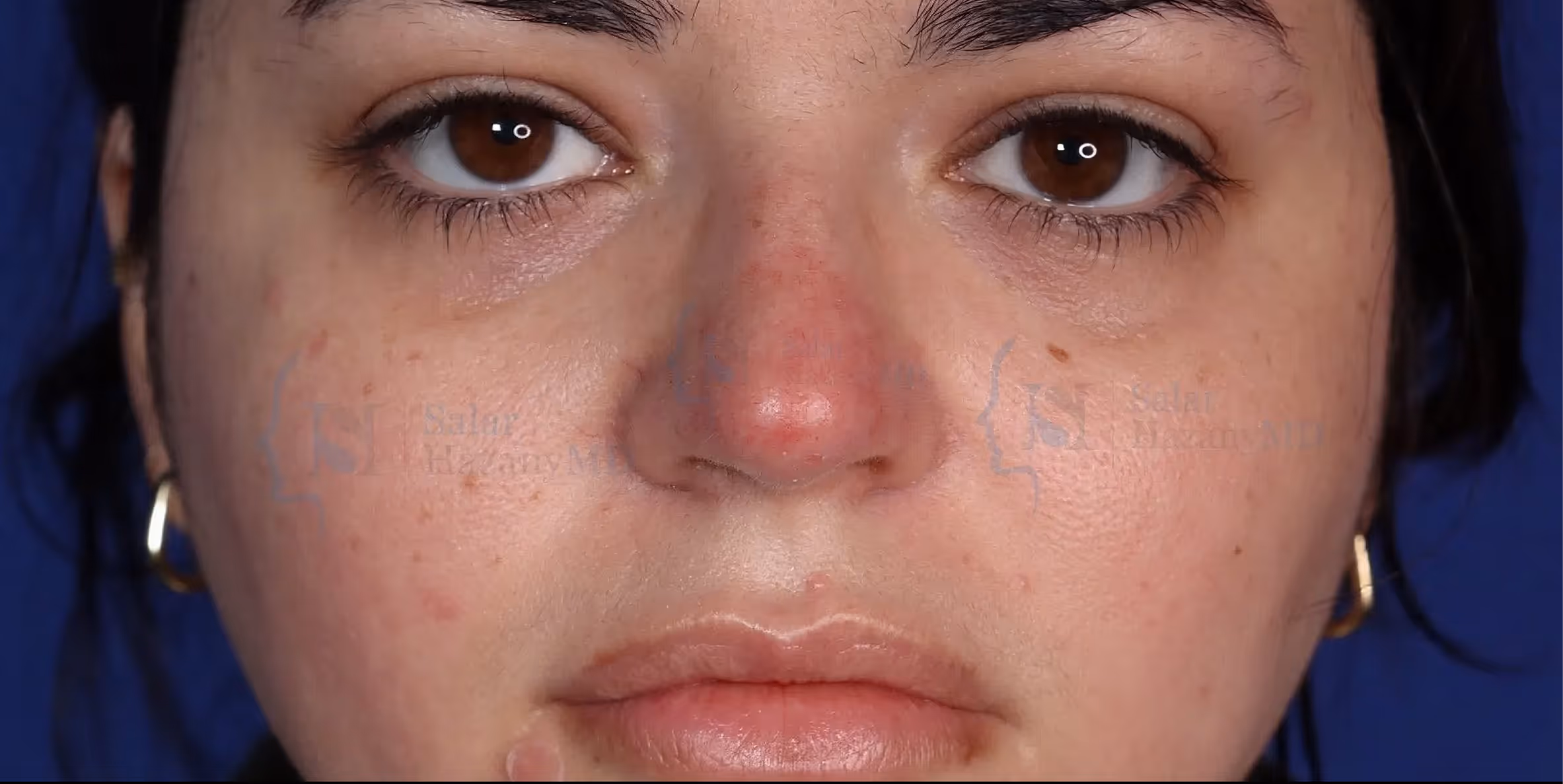 Close-up of a woman's face with a red, inflamed bump on the nose and some freckles.