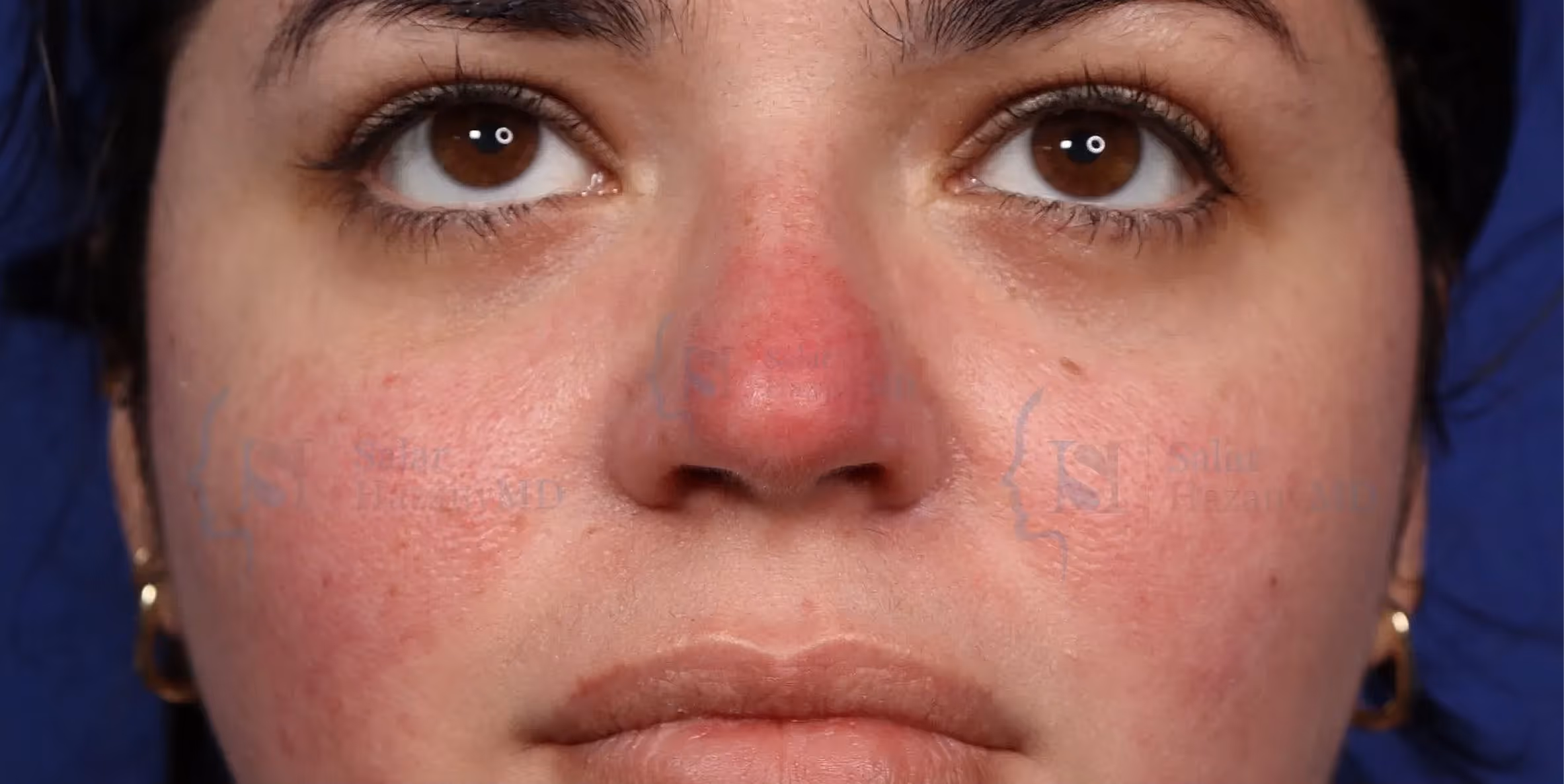 Close-up of a face with redness and irritation mainly on the nose and cheeks.
