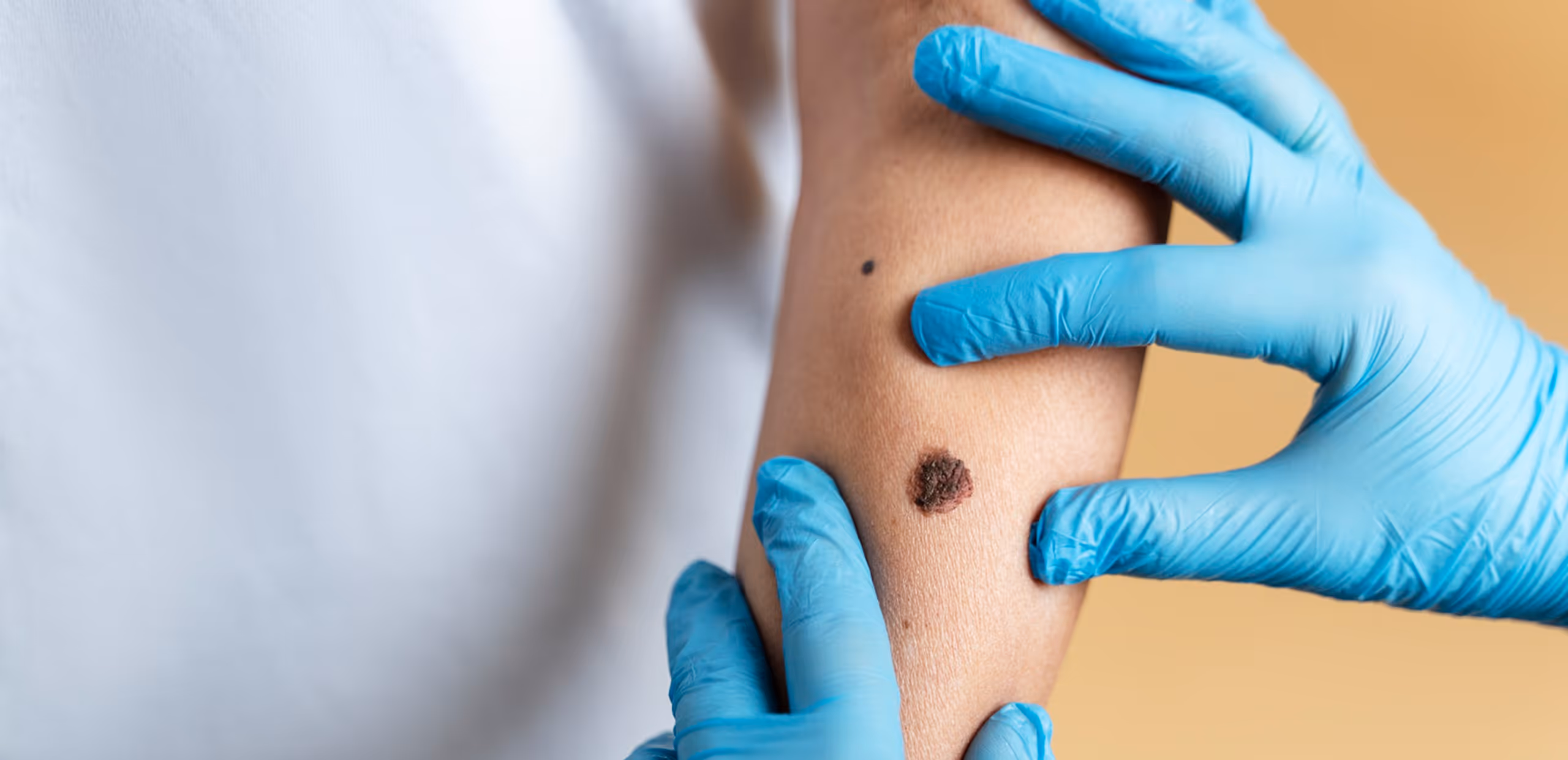 Doctor wearing blue gloves examines dark, irregular mole on patient's forearm.