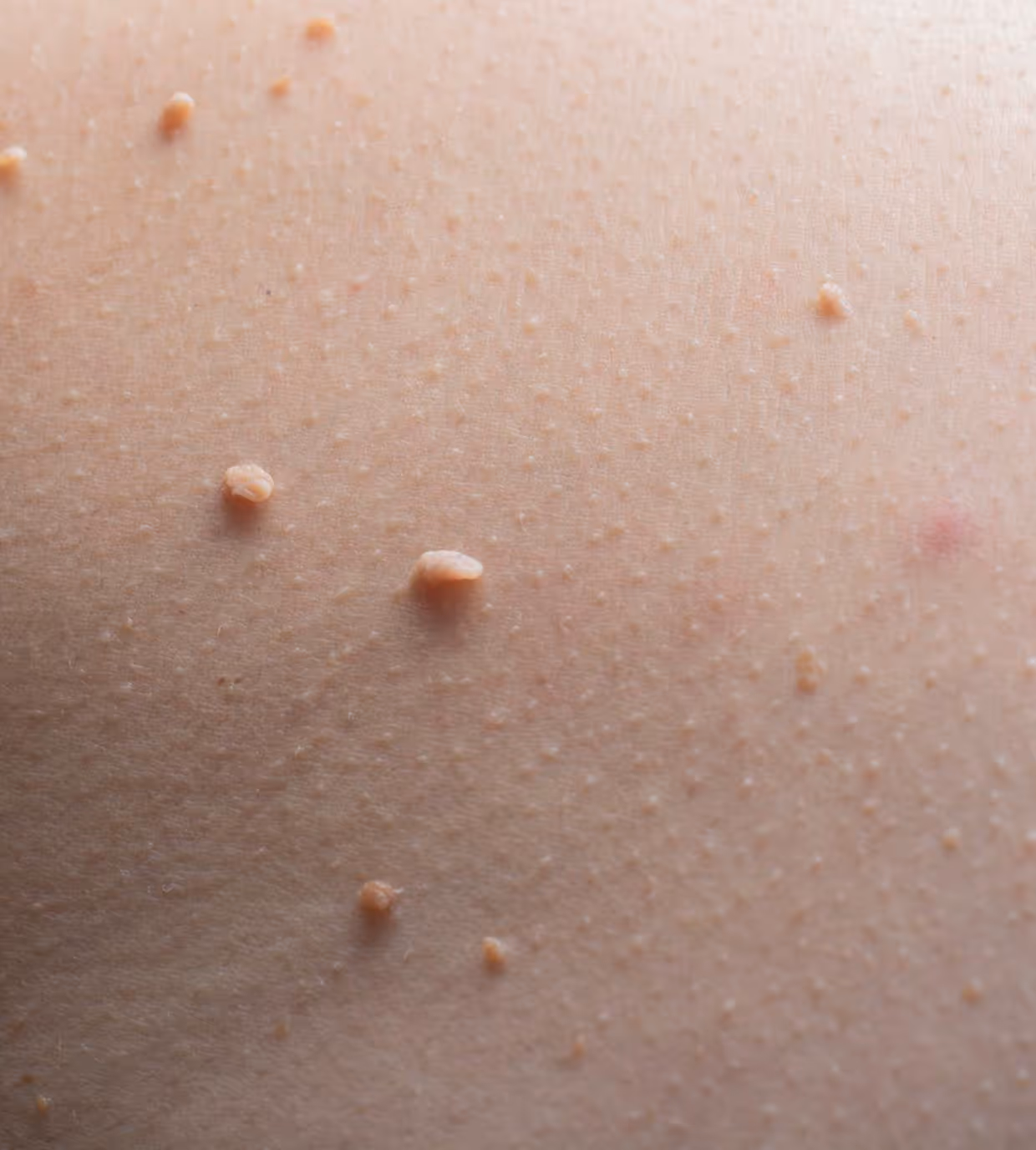Close-up of human skin with small flesh-colored skin tags and pores visible.