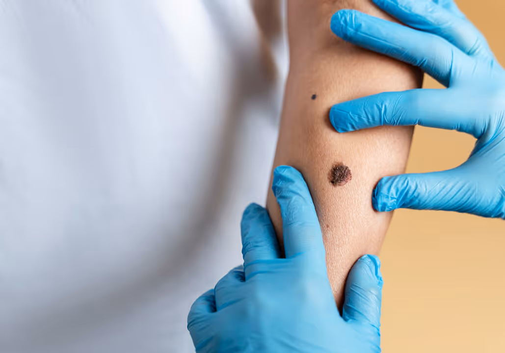 Hands in blue gloves examining a dark mole on a person's inner forearm against a beige background.